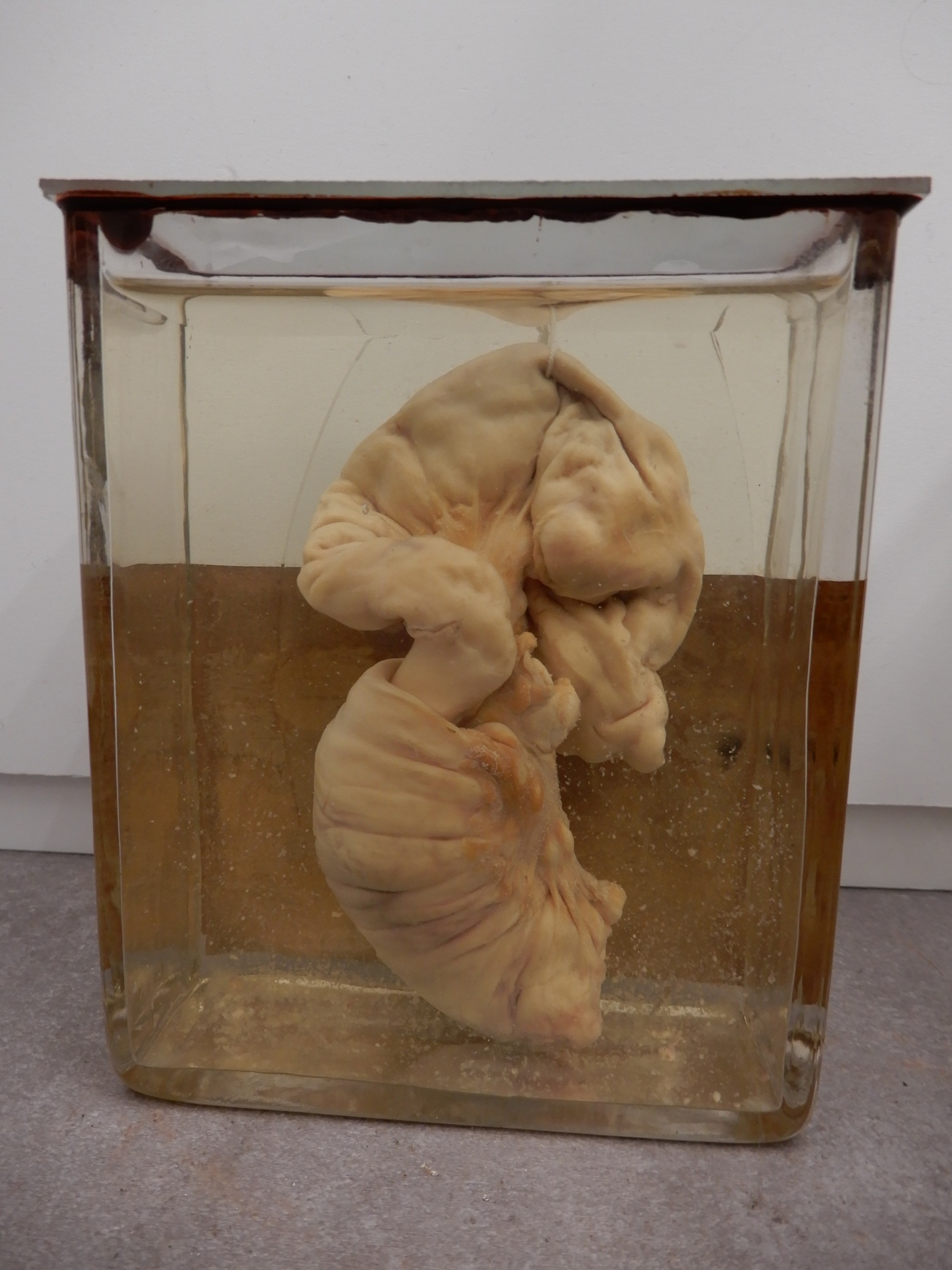 singolo reperto antropologico, preparato anatomico (morfologia alterata per patologia) (XIX-XX)