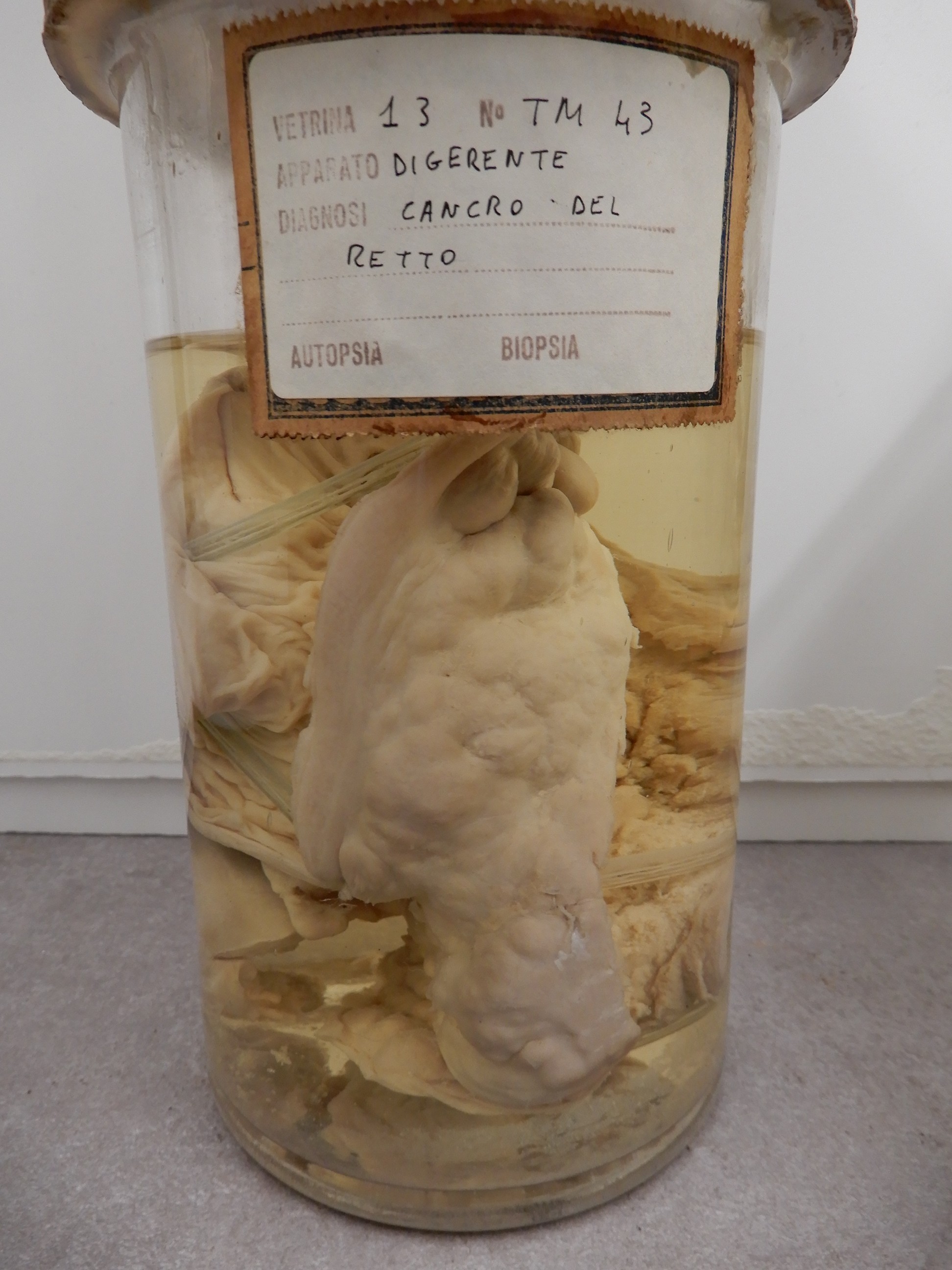 singolo reperto antropologico, preparato anatomico (morfologia alterata per patologia) (XIX-XX)