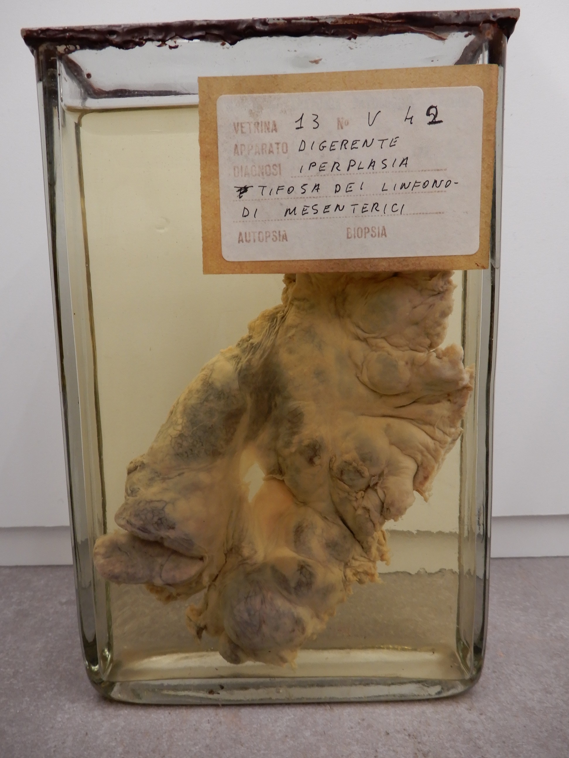 singolo reperto antropologico, preparato anatomico (morfologia alterata per patologia) (XIX-XX)