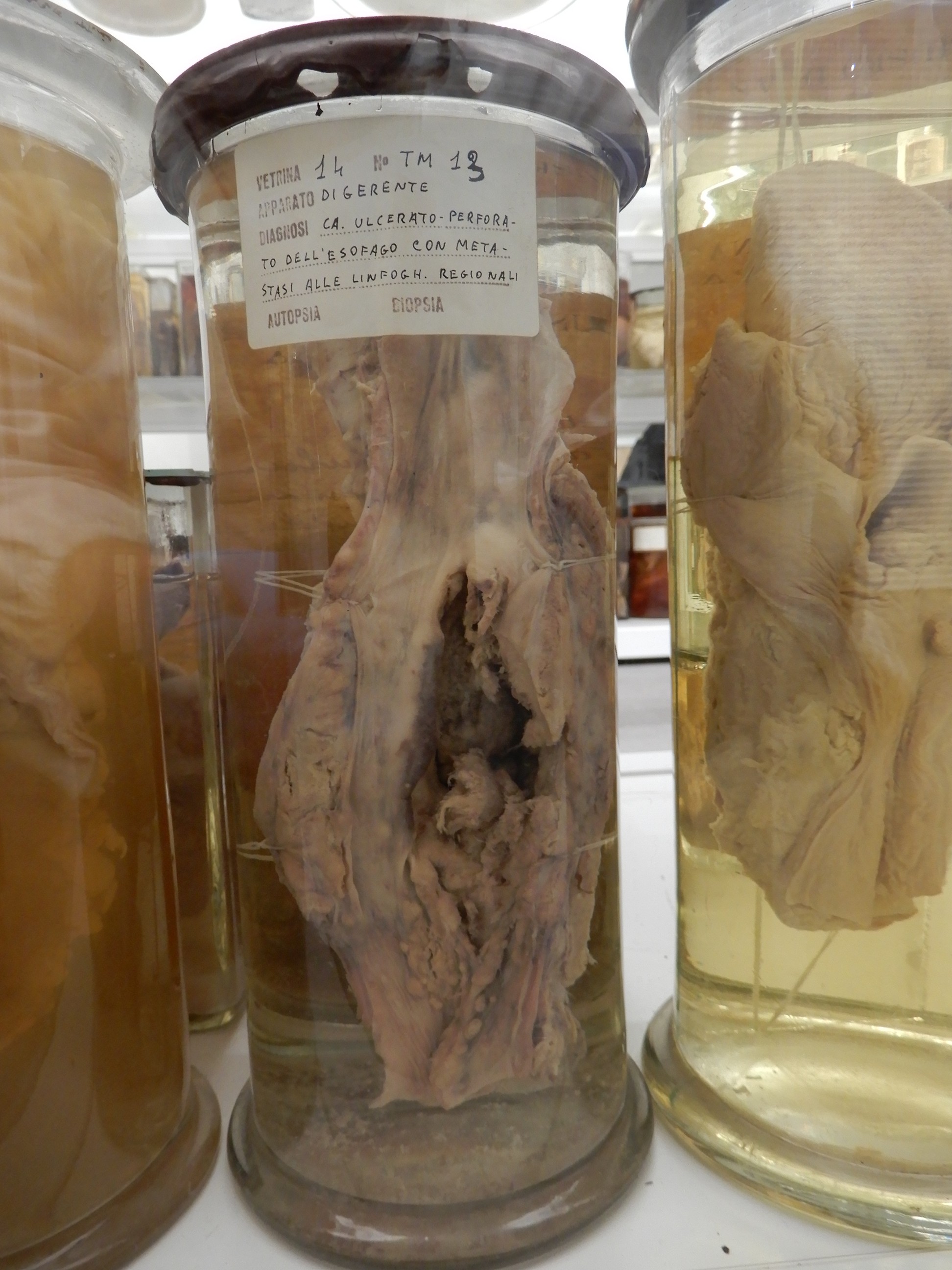 singolo reperto antropologico, preparato anatomico (morfologia alterata per patologia) (XIX-XX)