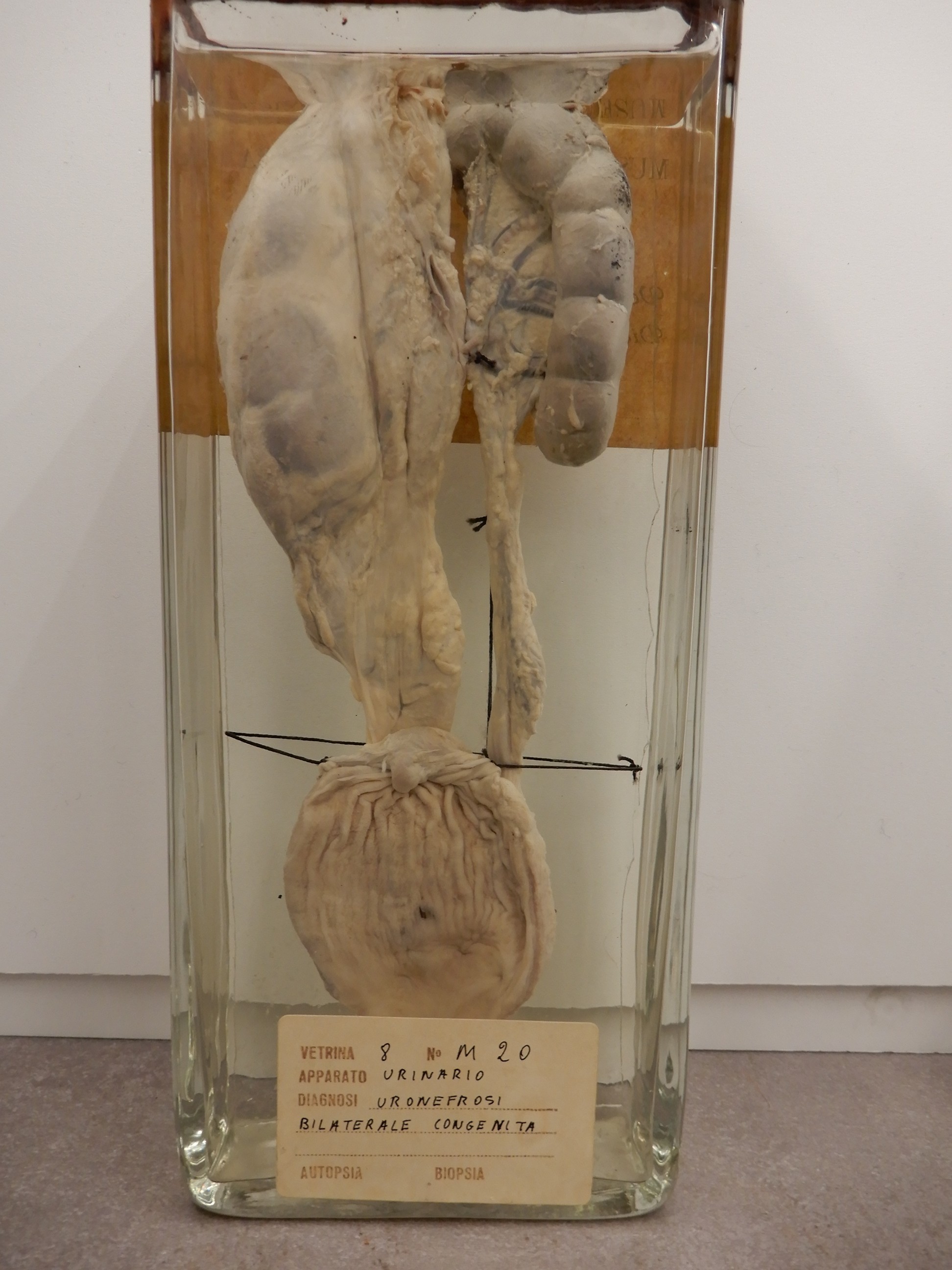 singolo reperto antropologico, preparato anatomico (morfologia alterata per patologia) (XIX-XX)