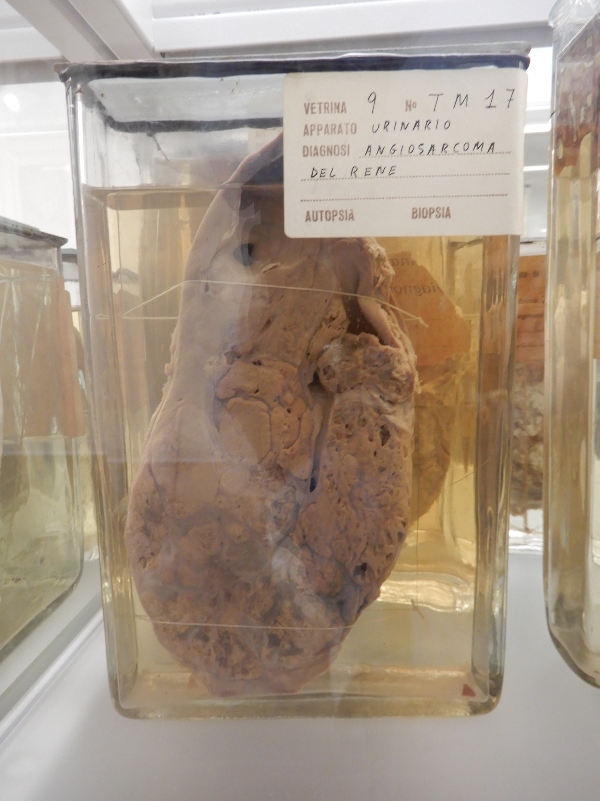 singolo reperto antropologico, preparato anatomico (morfologia alterata per patologia) (XIX-XX)