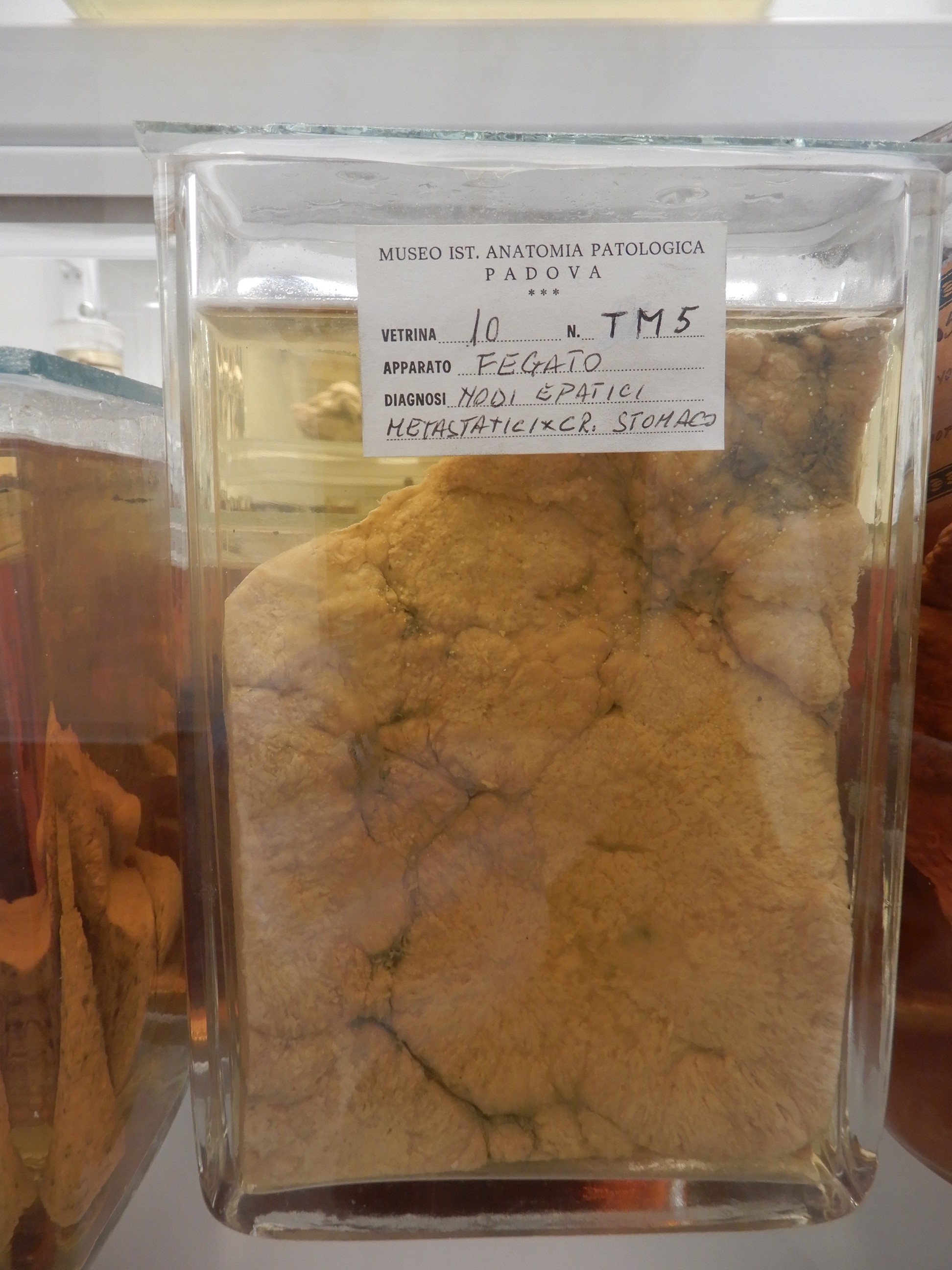 singolo reperto antropologico, preparato anatomico (morfologia alterata per patologia) (XIX-XX)