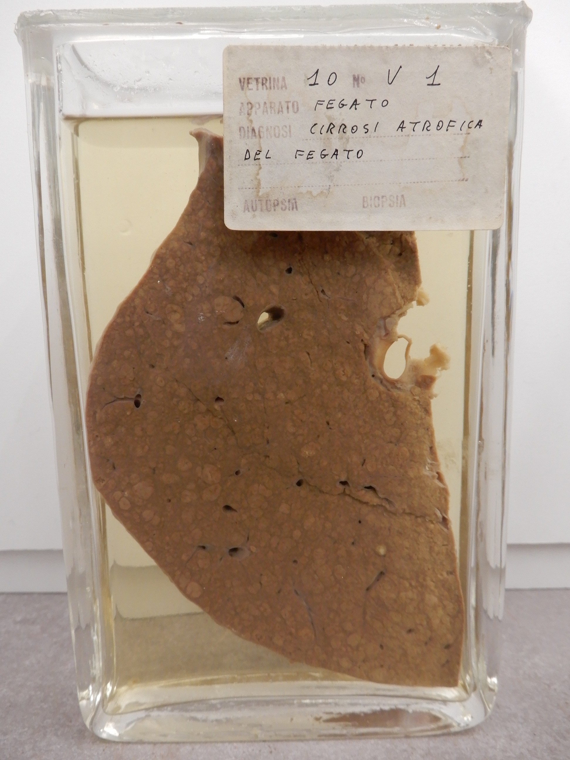 singolo reperto antropologico, preparato anatomico (morfologia alterata per patologia) (XIX-XX)