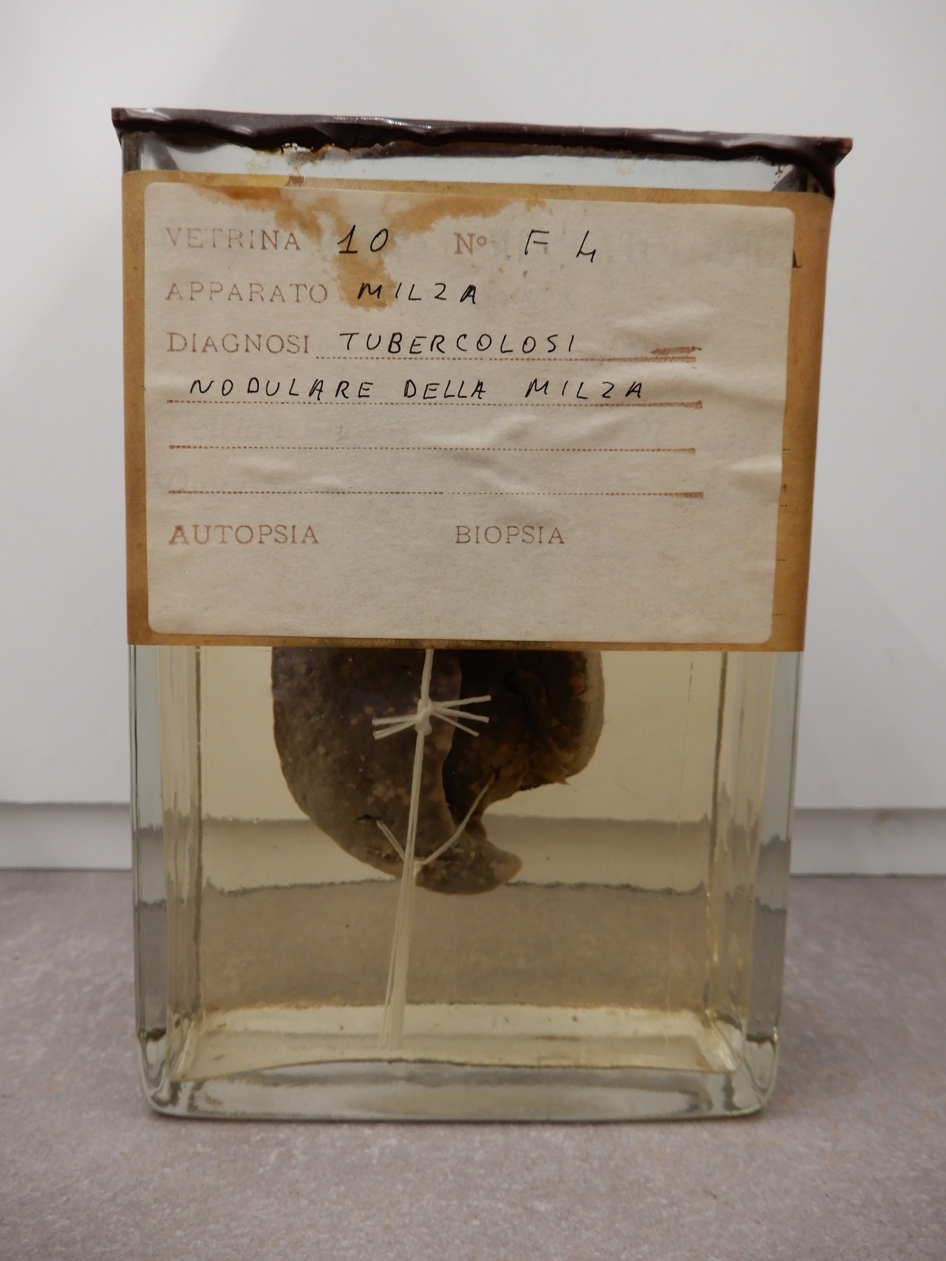 singolo reperto antropologico, preparato anatomico (morfologia alterata per patologia) (XIX-XX)