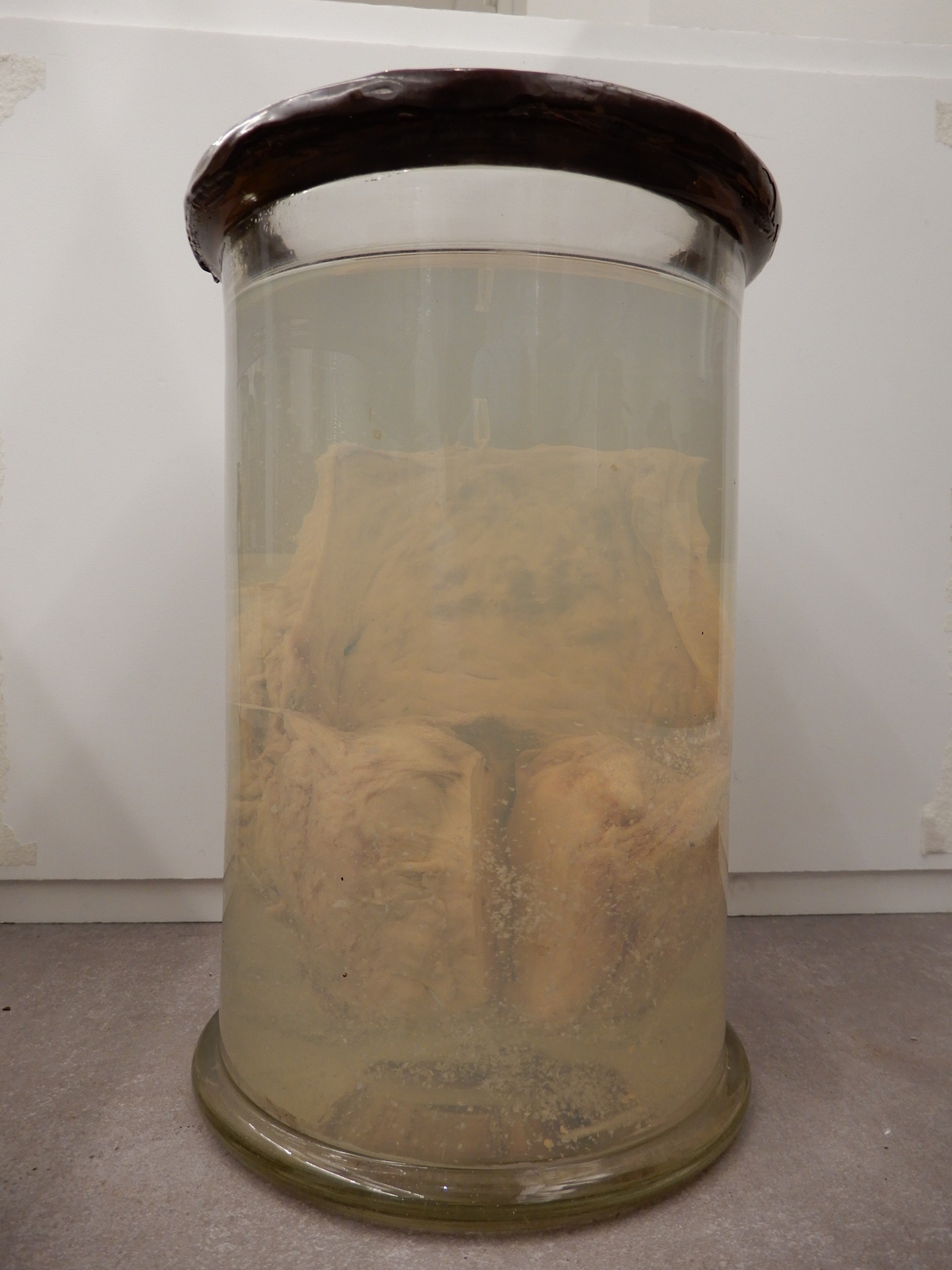 singolo reperto antropologico, preparato anatomico (morfologia alterata per patologia) (XIX-XX)