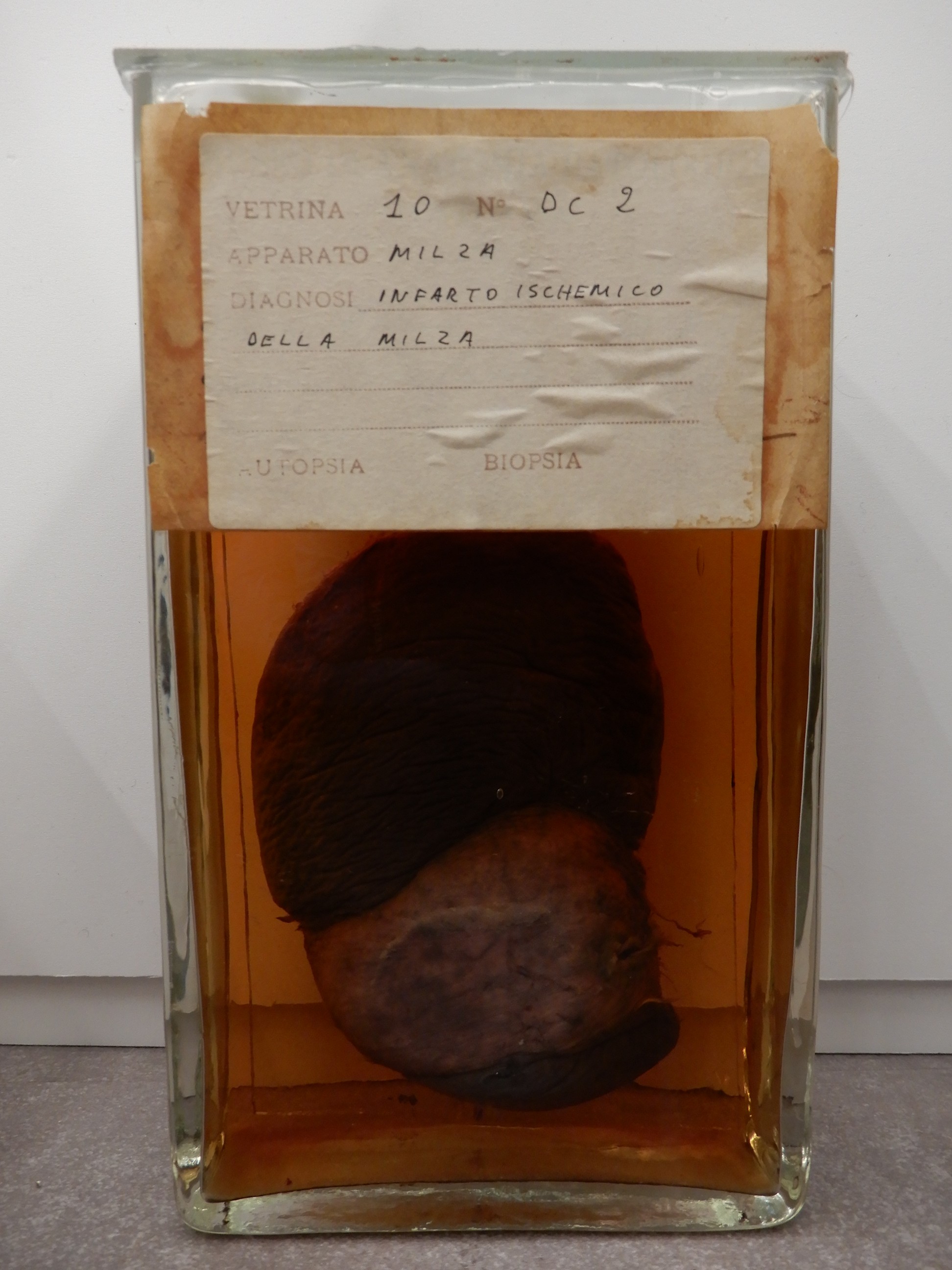 singolo reperto antropologico, preparato anatomico (morfologia alterata per patologia) (XIX-XX)