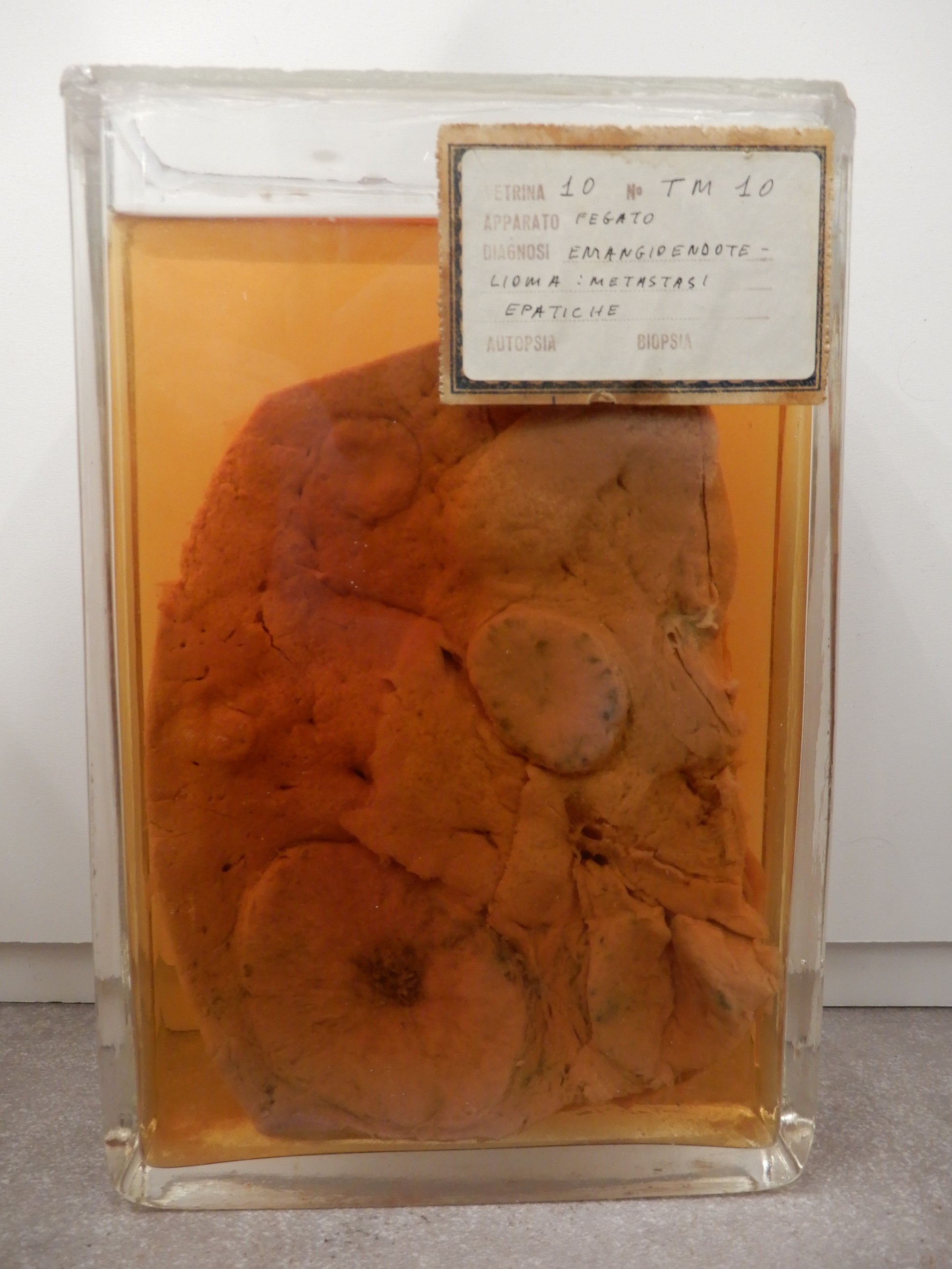 singolo reperto antropologico, preparato anatomico (morfologia alterata per patologia) (XIX-XX)