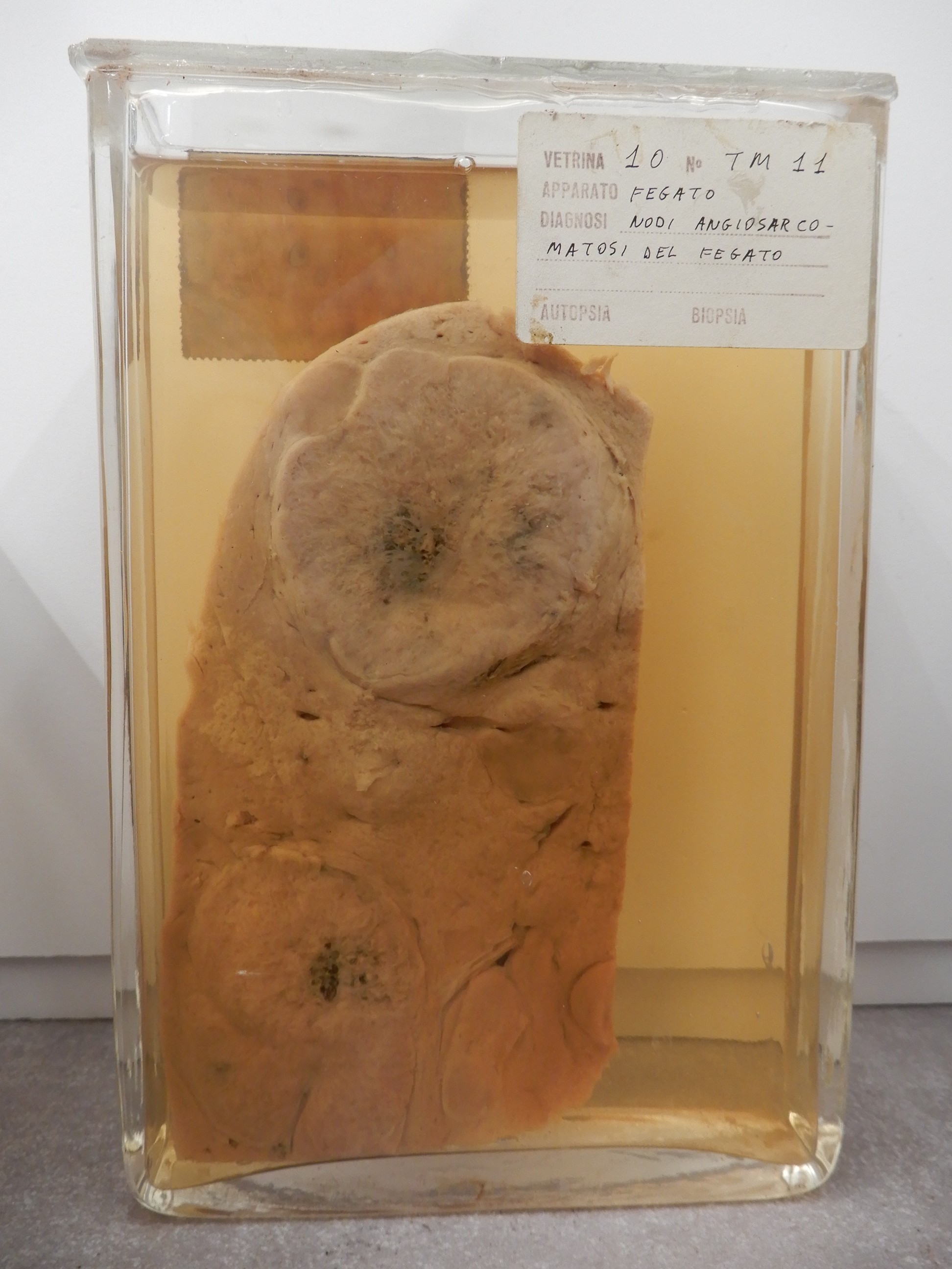 singolo reperto antropologico, preparato anatomico (morfologia alterata per patologia) (XIX-XX)