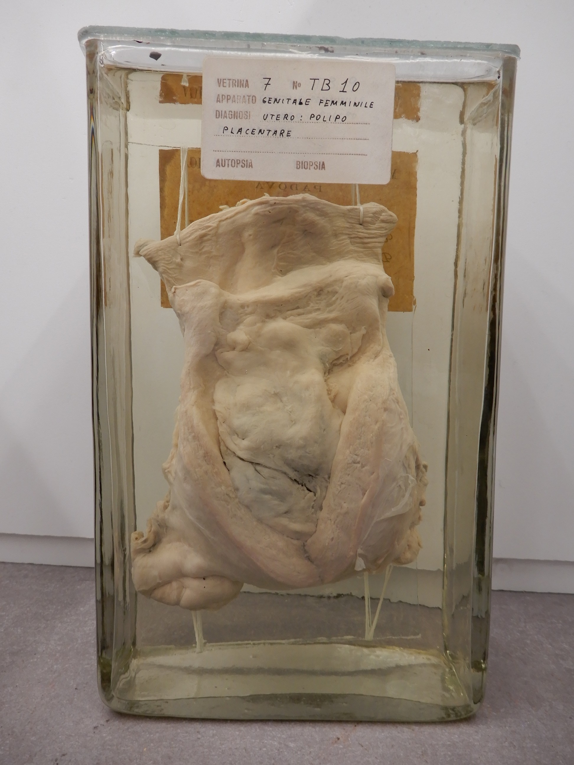 singolo reperto antropologico, preparato anatomico (morfologia alterata per patologia) (XIX-XX)