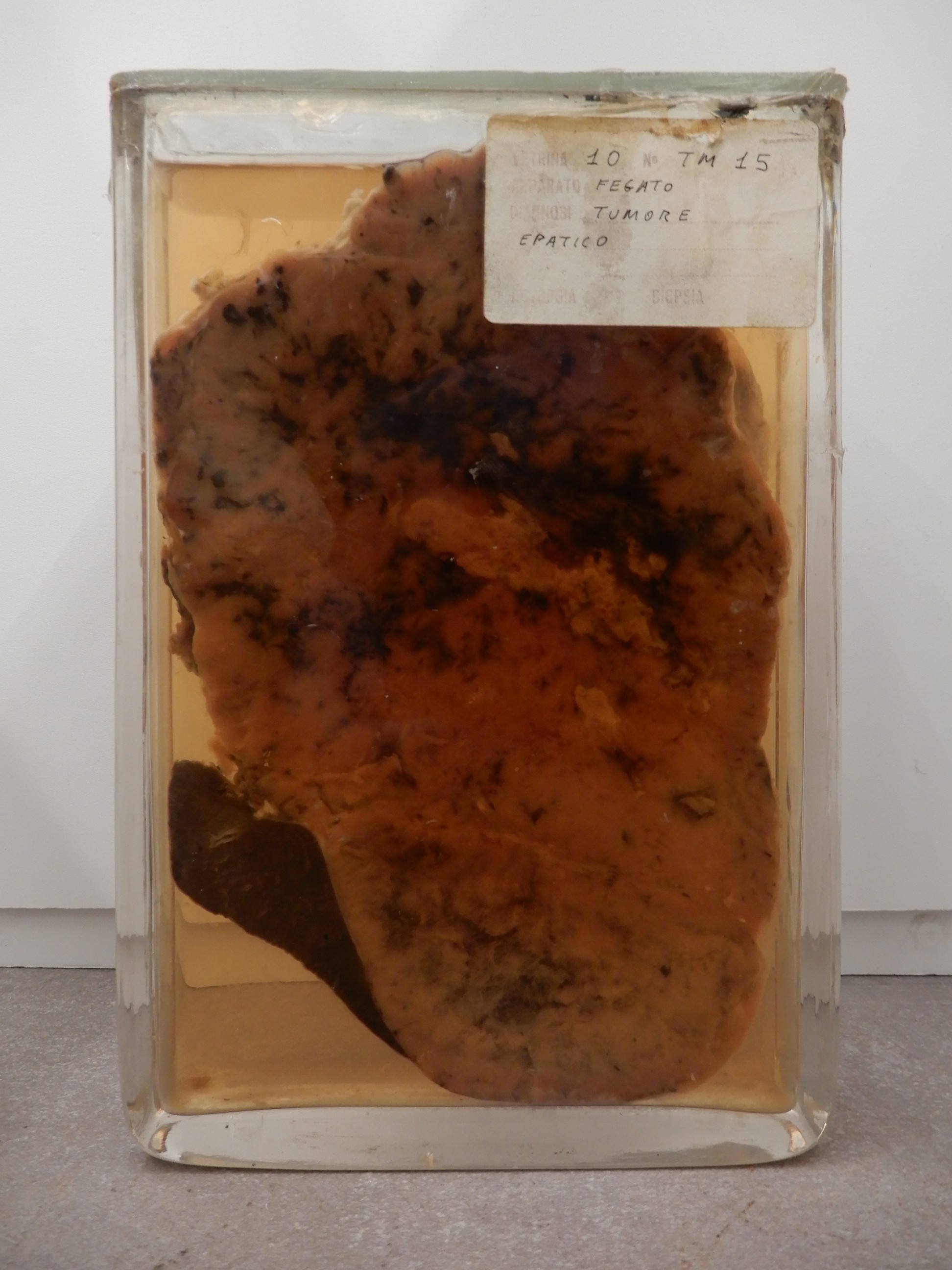 singolo reperto antropologico, preparato anatomico (morfologia alterata per patologia) (XIX-XX)