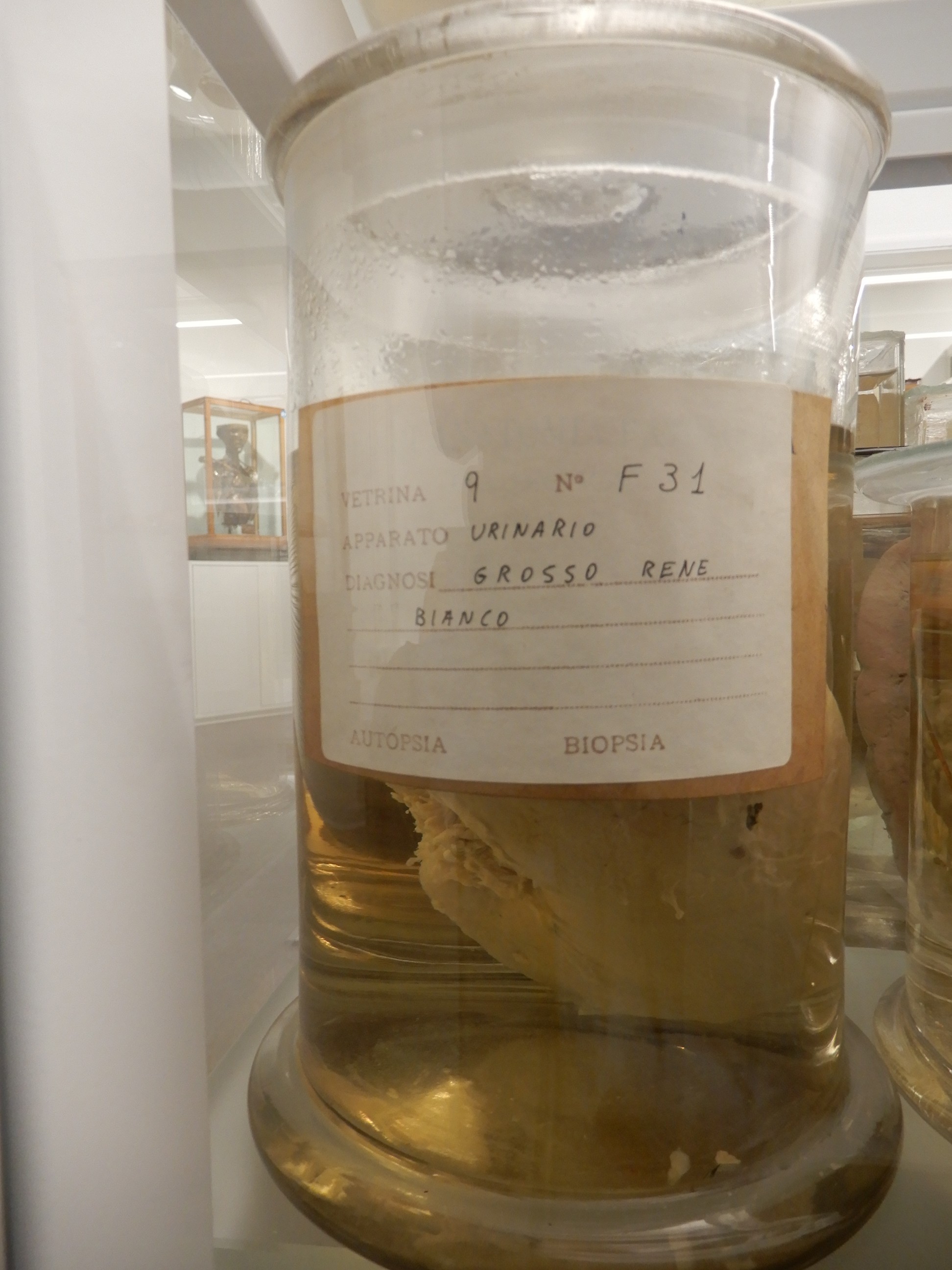 singolo reperto antropologico, preparato anatomico (morfologia alterata per patologia) (XIX-XX)