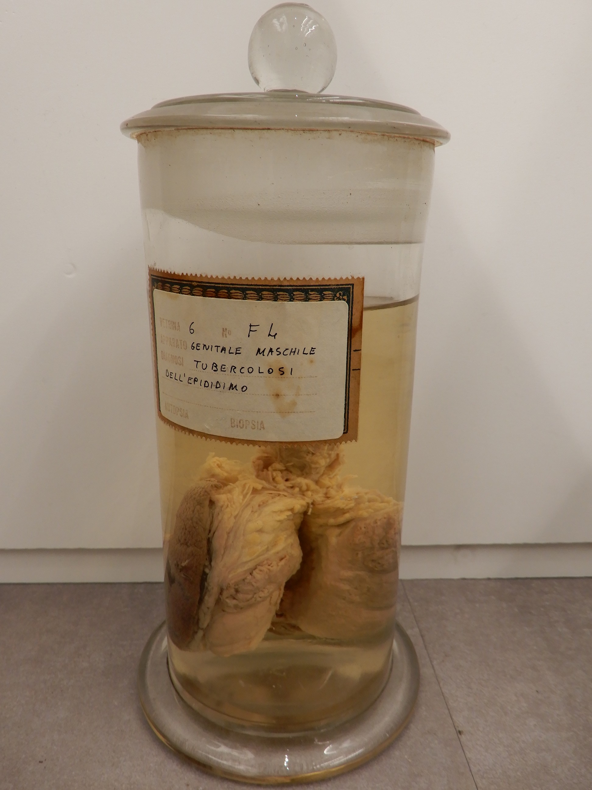 singolo reperto antropologico, preparato anatomico (morfologia alterata per patologia) (XIX-XX)