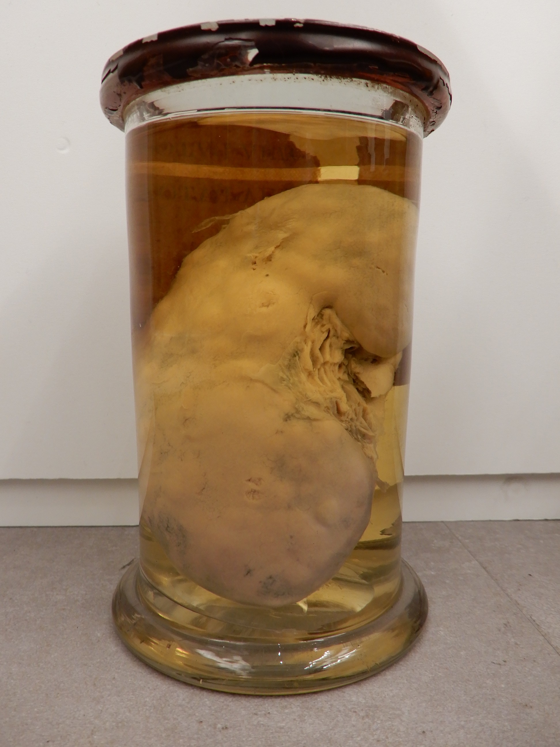 singolo reperto antropologico, preparato anatomico (morfologia alterata per patologia) (XIX-XX)