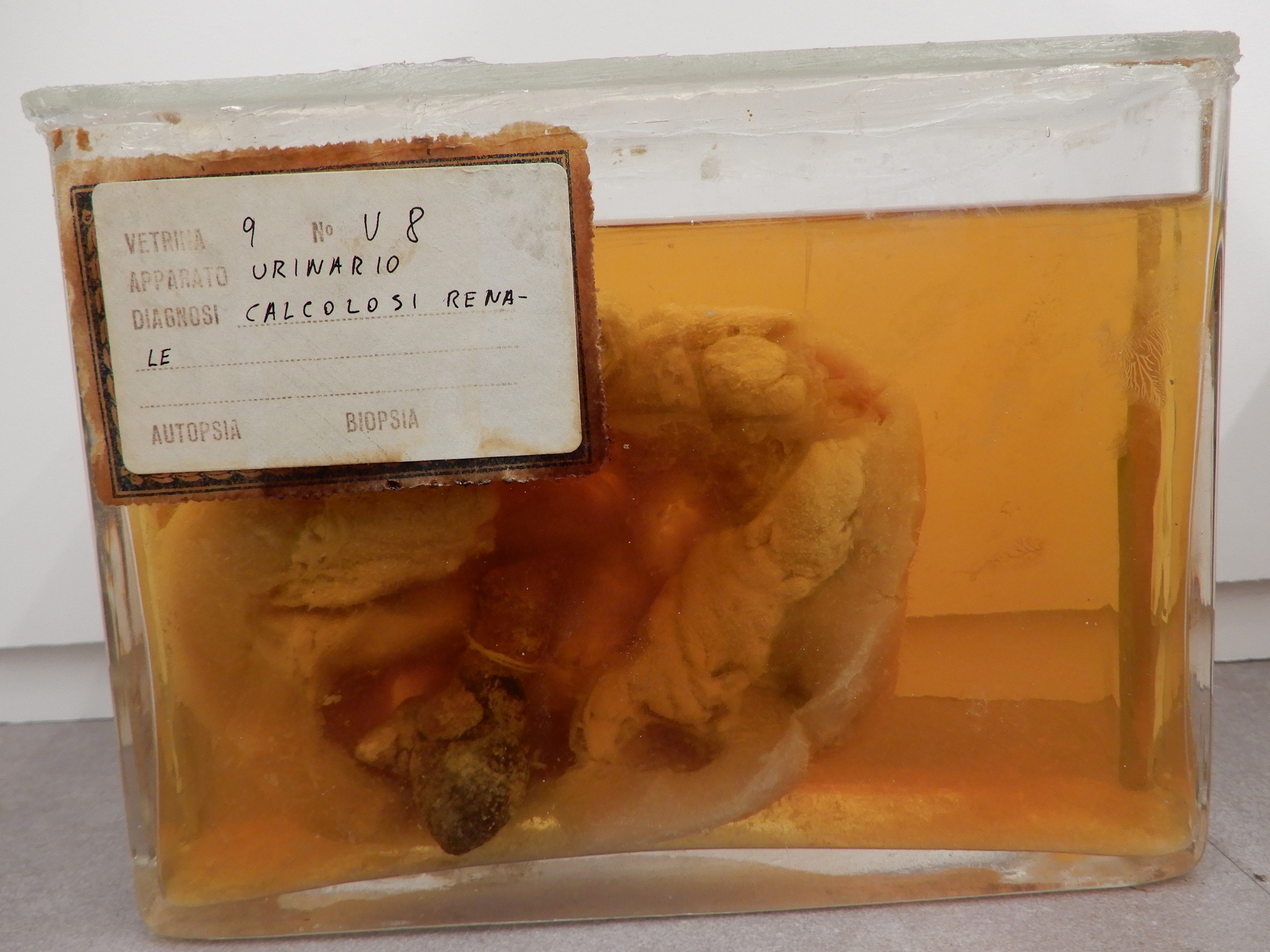 singolo reperto antropologico, preparato anatomico (morfologia alterata per patologia) (XIX-XX)