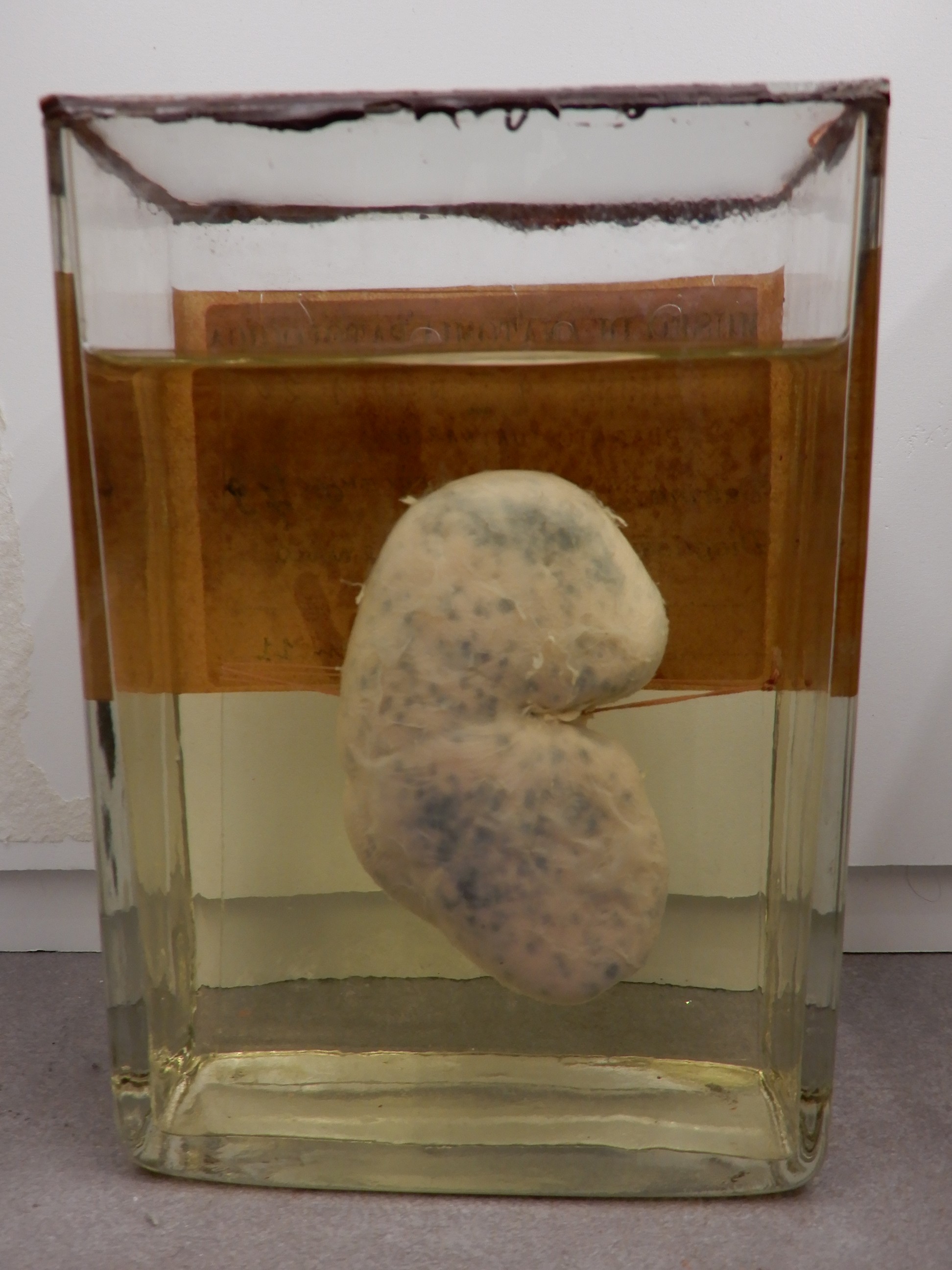 singolo reperto antropologico, preparato anatomico (morfologia alterata per patologia) (XIX-XX)