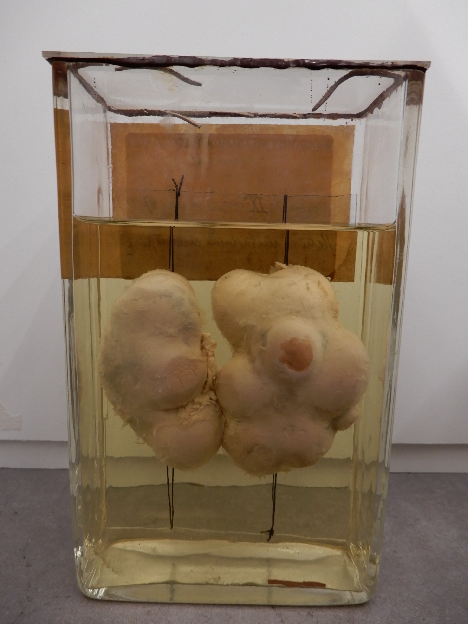 singolo reperto antropologico, preparato anatomico (morfologia alterata per patologia) (XIX-XX)