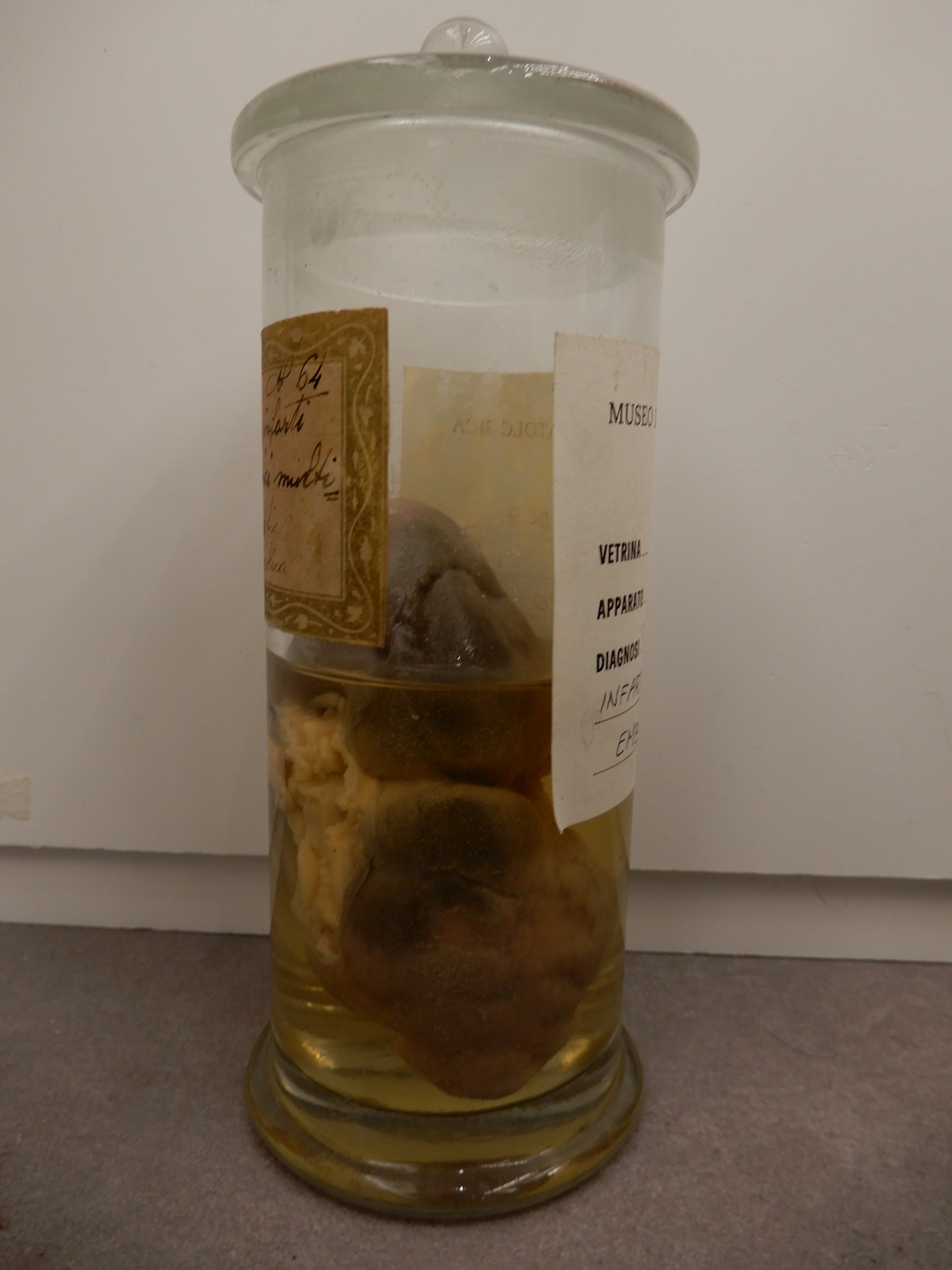 singolo reperto antropologico, preparato anatomico (morfologia alterata per patologia) (XIX-XX)