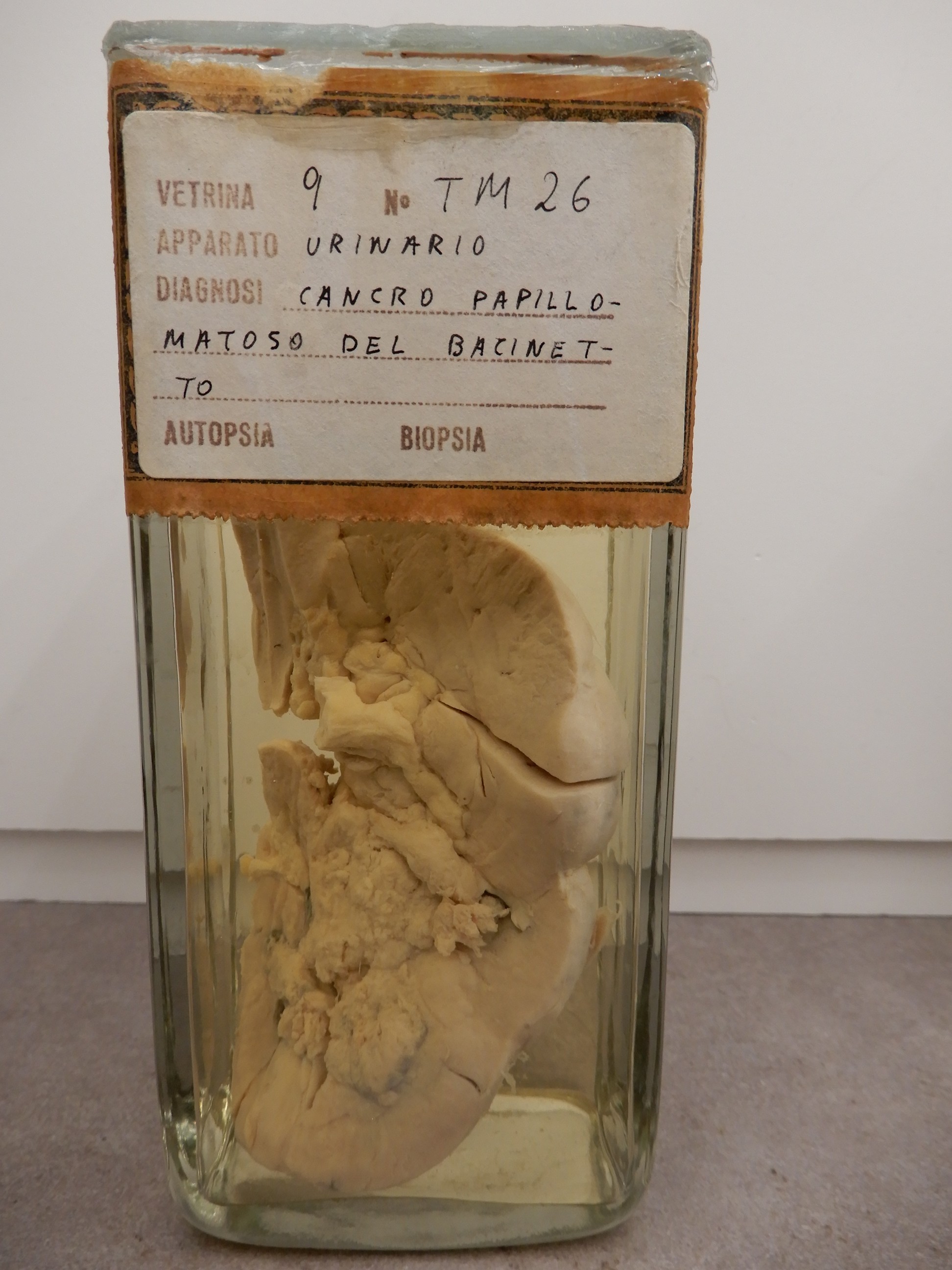 singolo reperto antropologico, preparato anatomico (morfologia alterata per patologia) (XIX-XX)