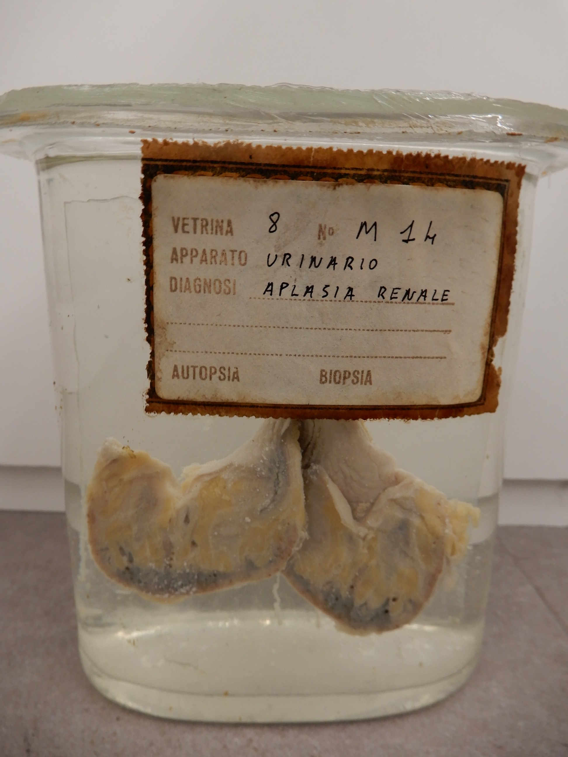 singolo reperto antropologico, preparato anatomico (morfologia alterata per patologia) (XIX-XX)