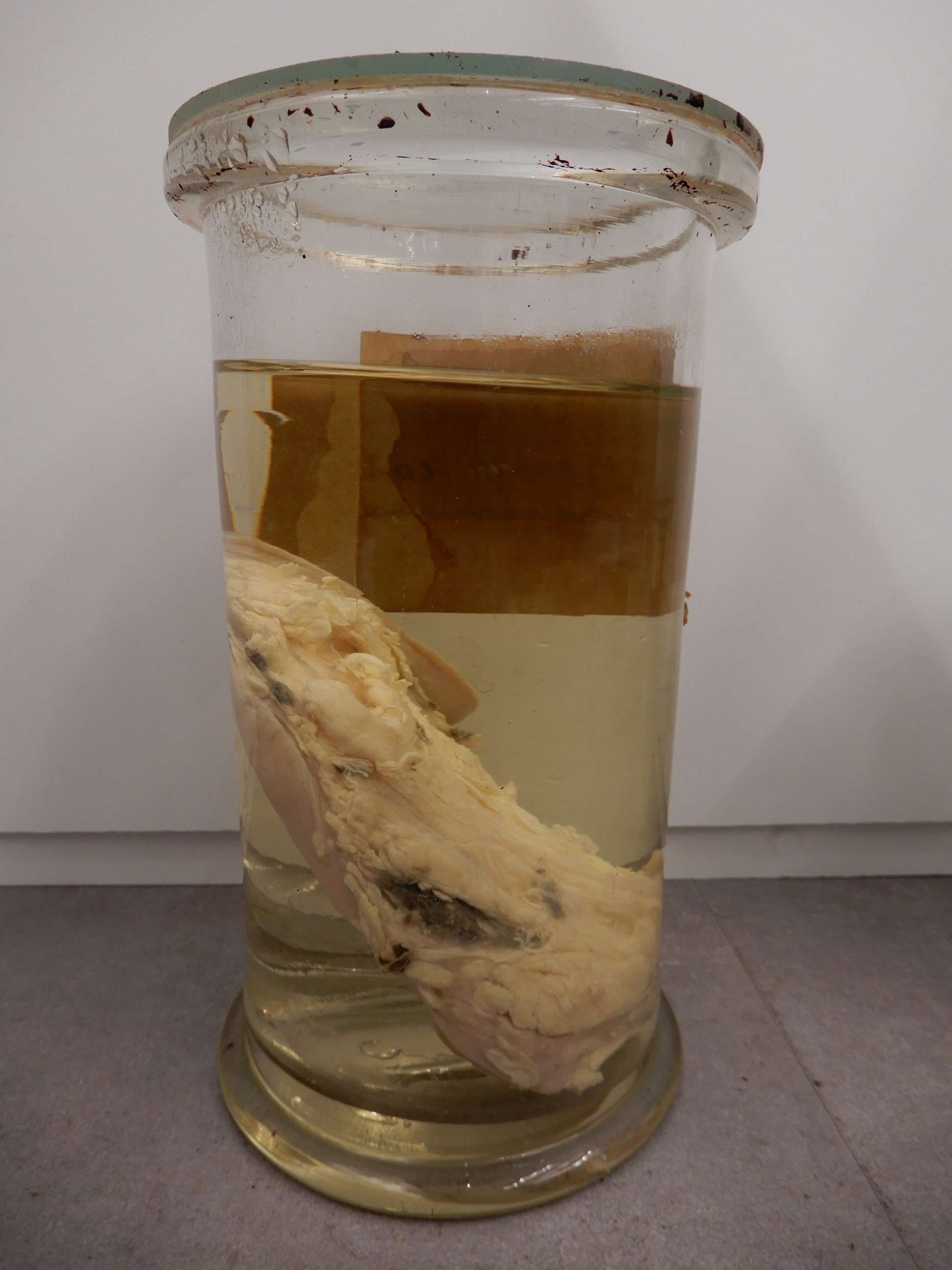 singolo reperto antropologico, preparato anatomico (morfologia alterata per patologia) (XIX-XX)