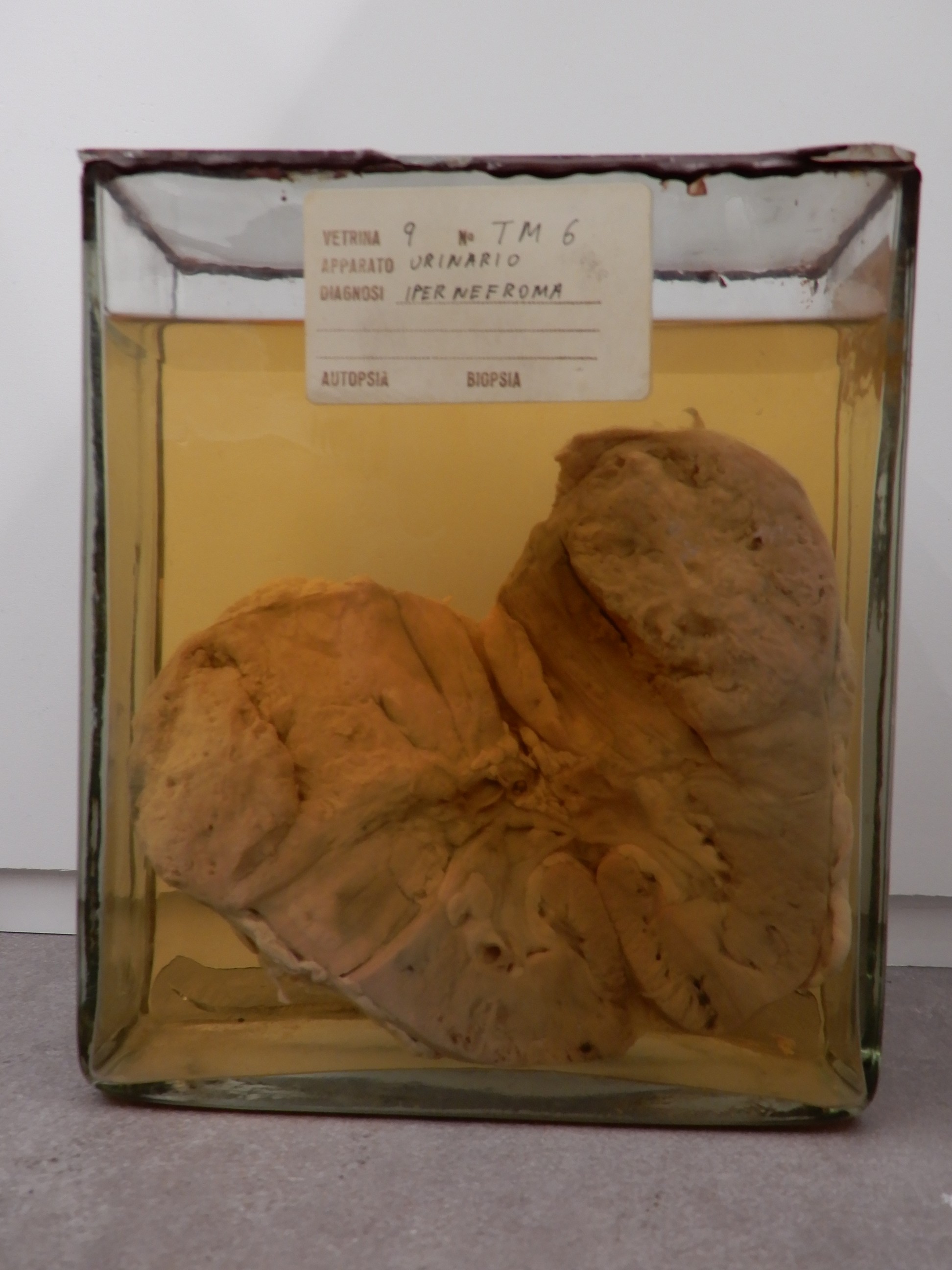 singolo reperto antropologico, preparato anatomico (morfologia alterata per patologia) (XIX-XX)