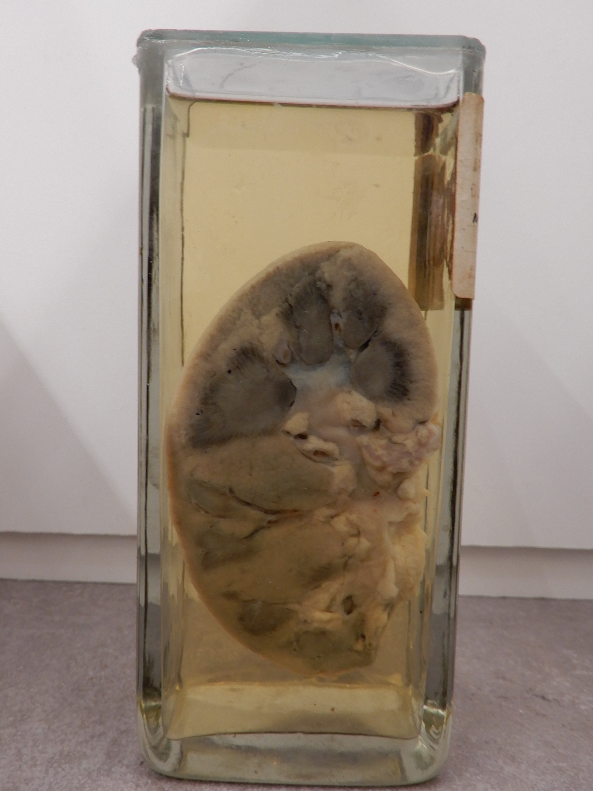 singolo reperto antropologico, preparato anatomico (morfologia alterata per patologia) (XIX-XX)