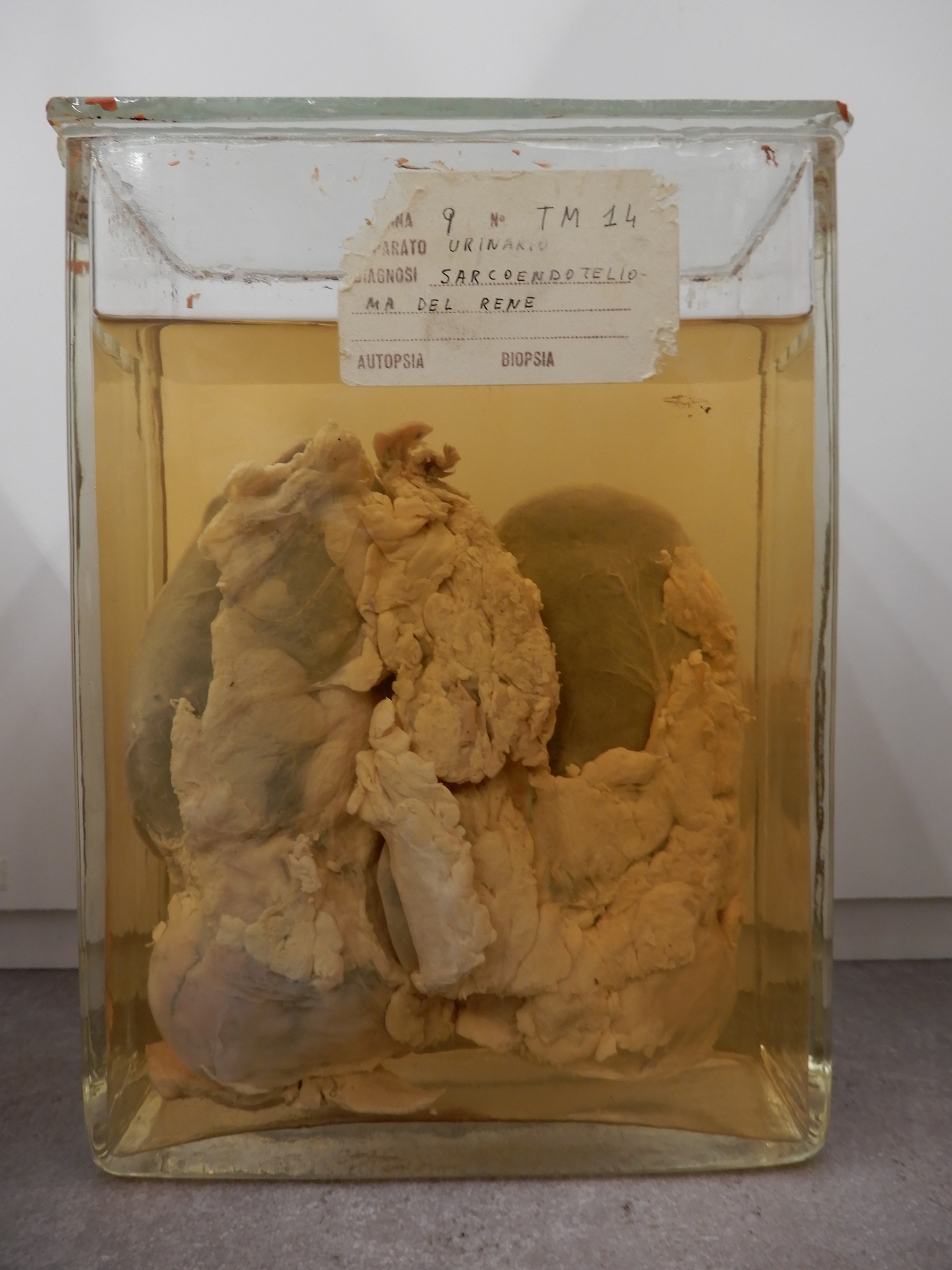 singolo reperto antropologico, preparato anatomico (morfologia alterata per patologia) (XIX-XX)