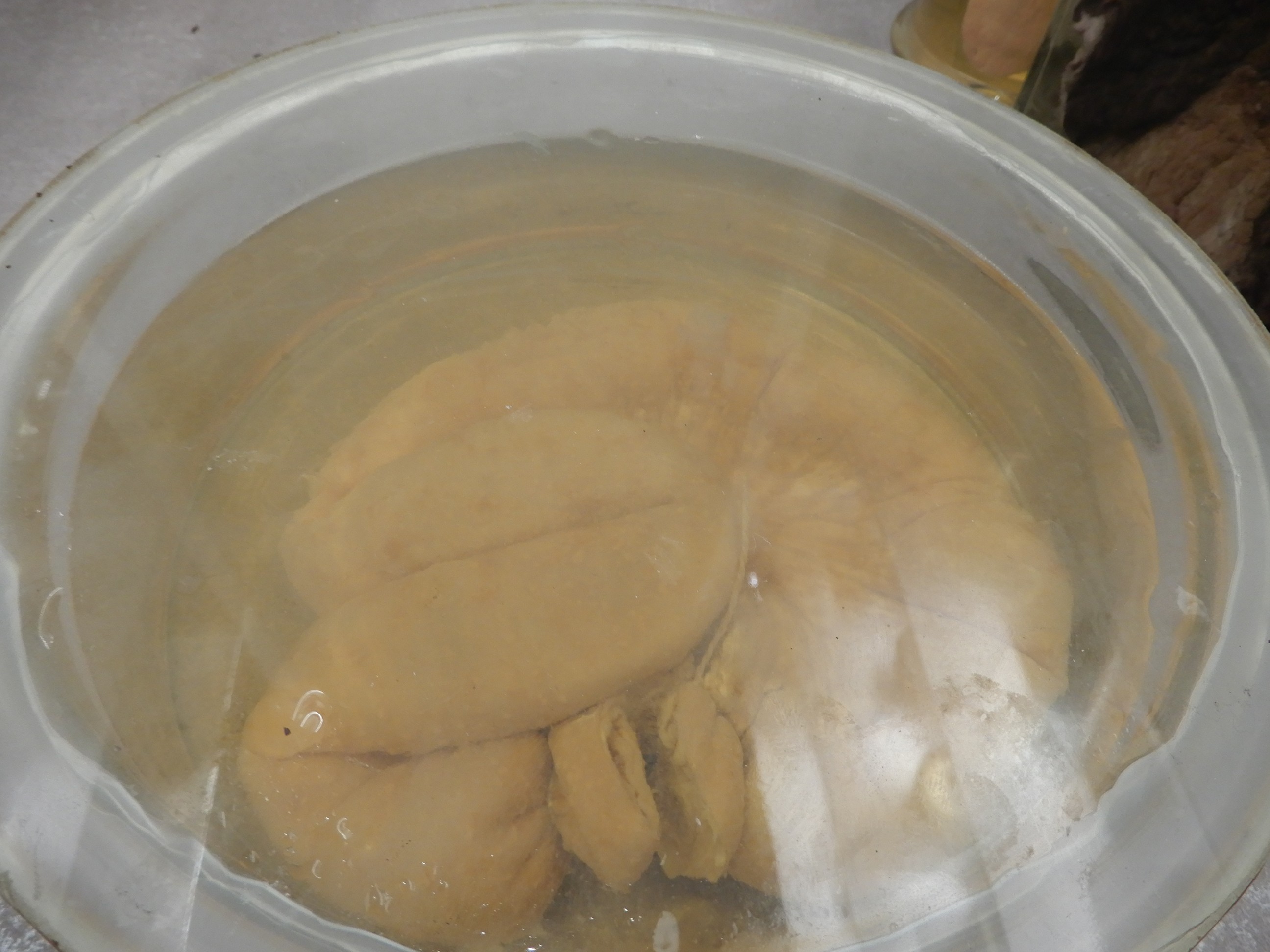 singolo reperto antropologico, preparato anatomico (morfologia alterata per patologia) (XIX-XX)