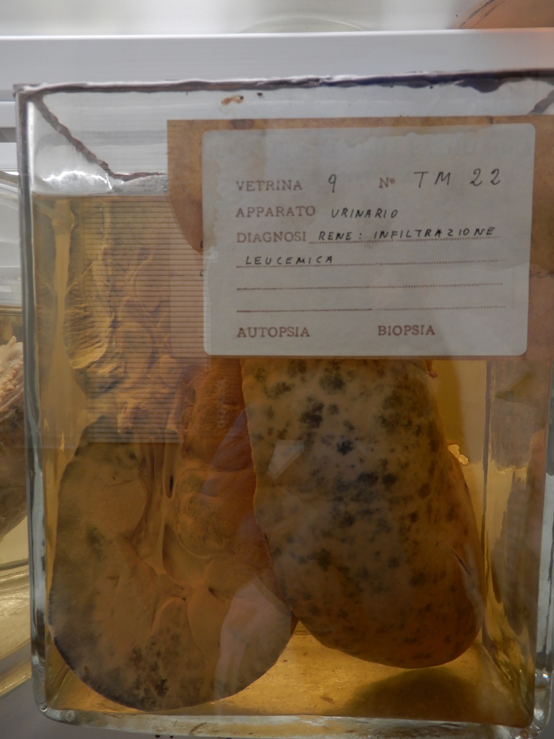 singolo reperto antropologico, preparato anatomico (morfologia alterata per patologia) (XIX-XX)