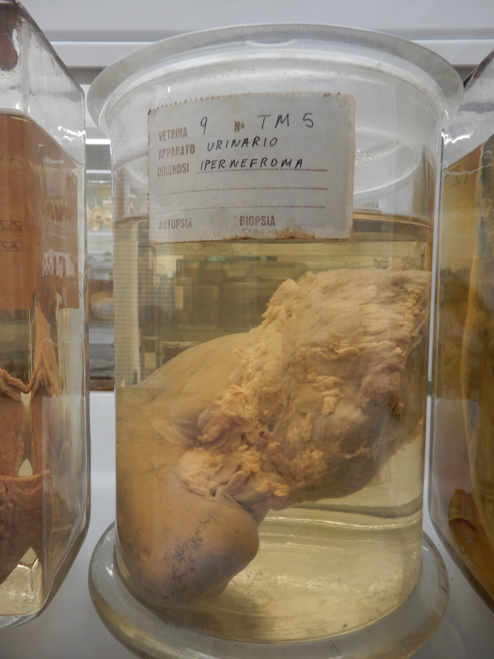 singolo reperto antropologico, preparato anatomico (morfologia alterata per patologia) (XIX-XX)