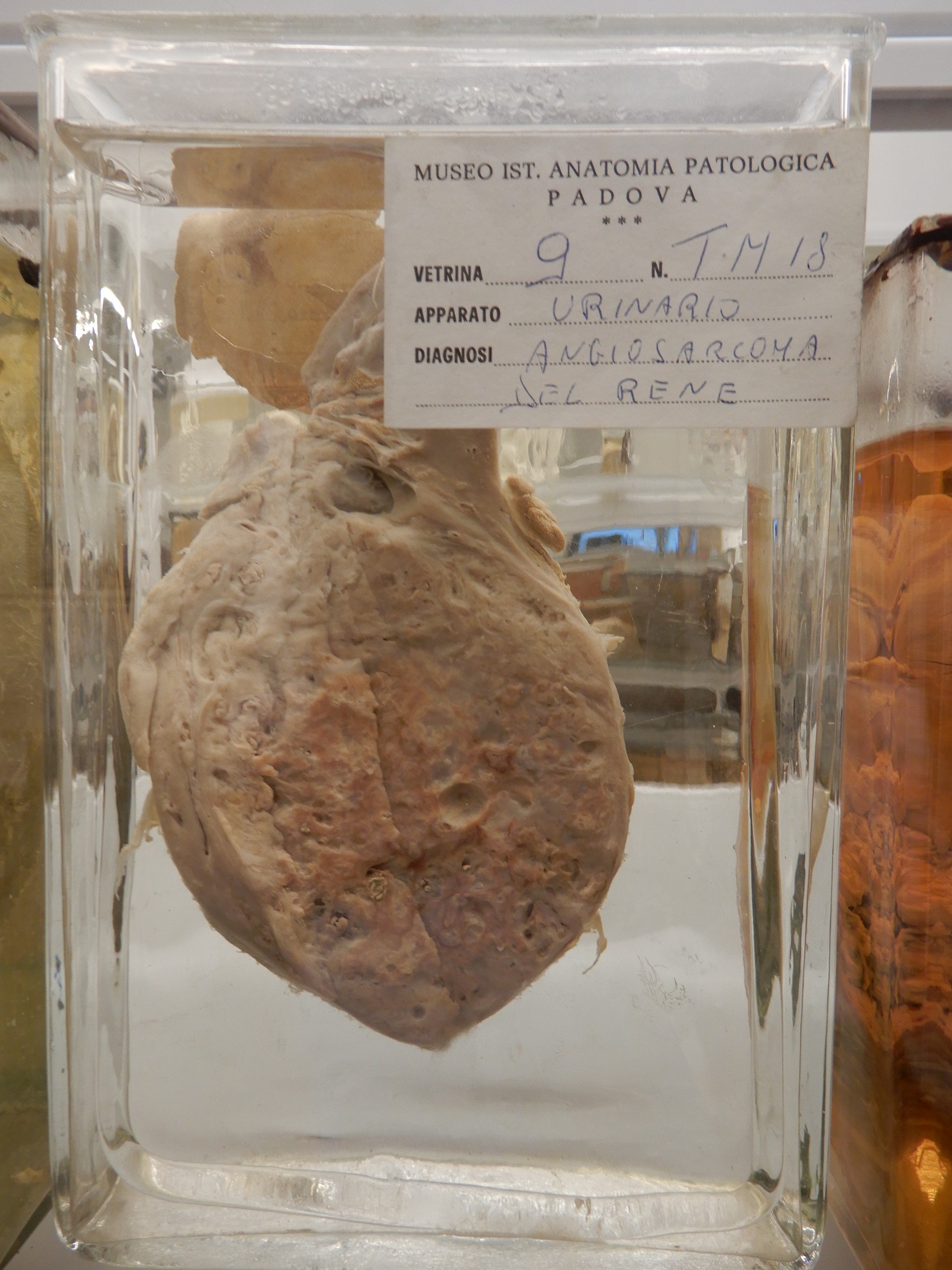 singolo reperto antropologico, preparato anatomico (morfologia alterata per patologia) (XIX-XX)