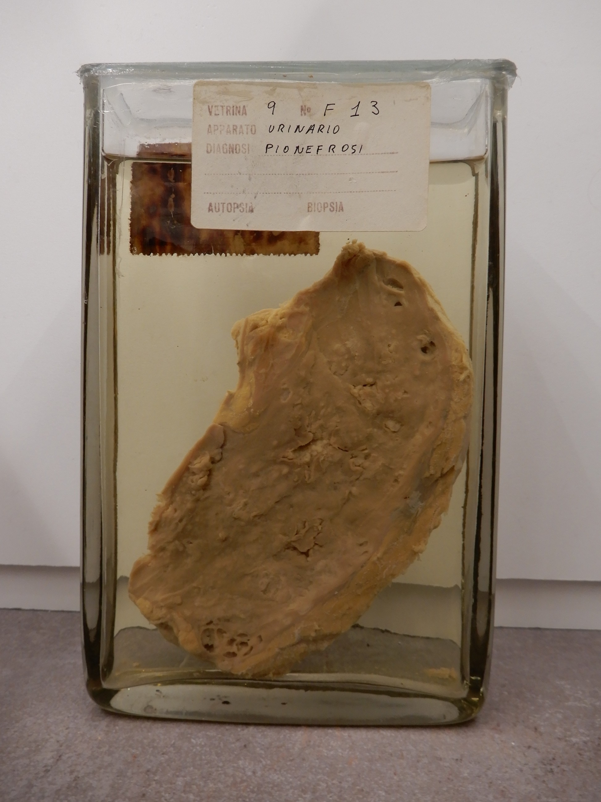 singolo reperto antropologico, preparato anatomico (morfologia alterata per patologia) (XIX-XX)