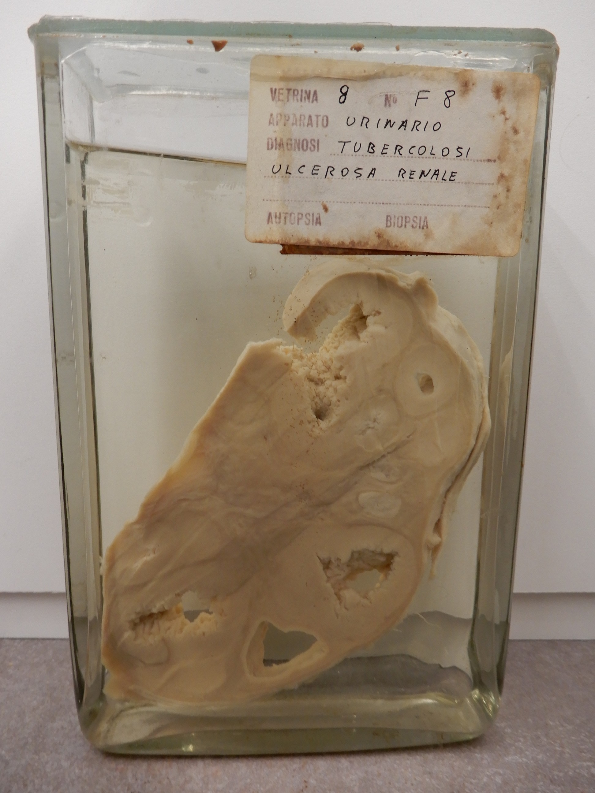 singolo reperto antropologico, preparato anatomico (morfologia alterata per patologia) (XIX-XX)