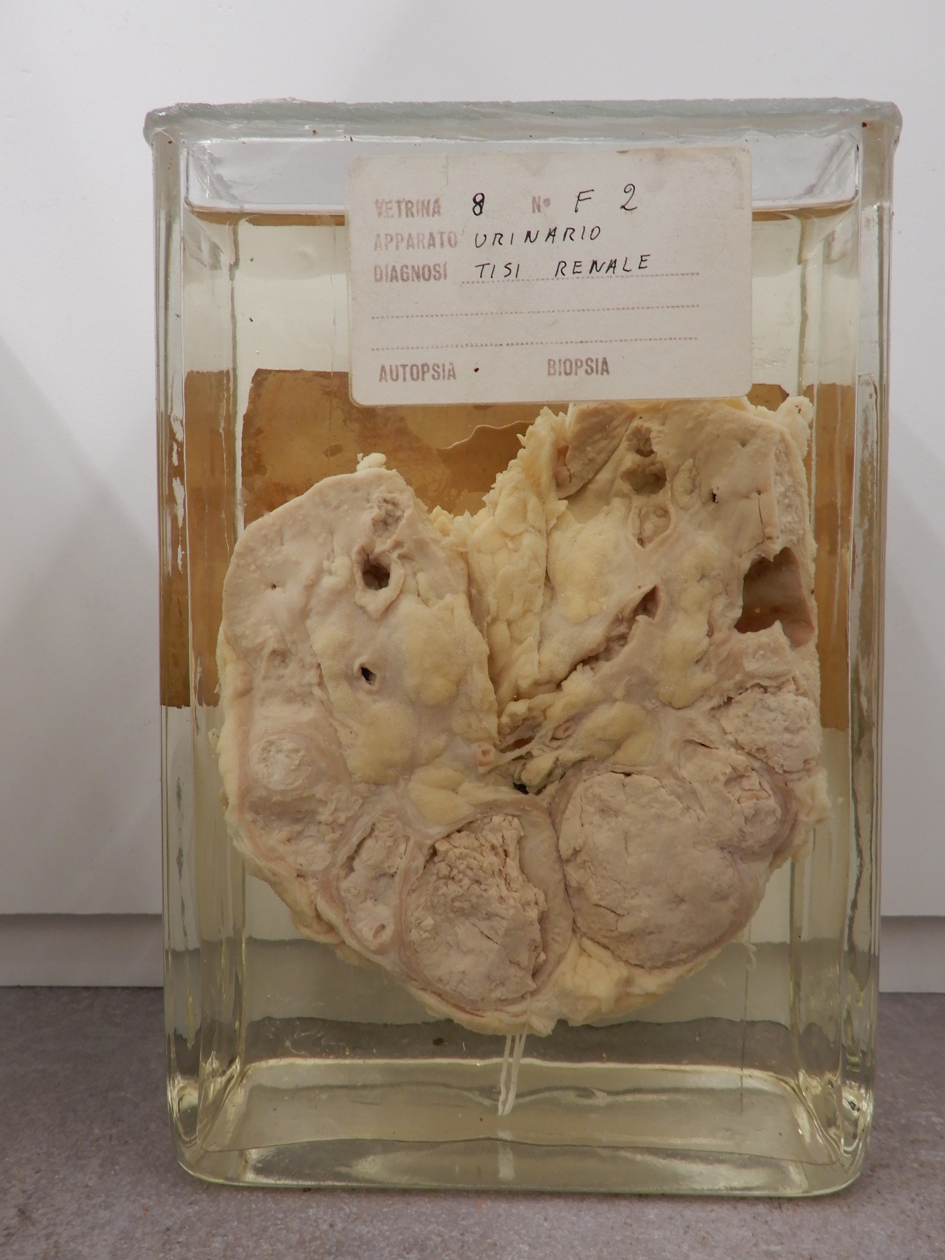 singolo reperto antropologico, preparato anatomico (morfologia alterata per patologia) (XIX-XX)