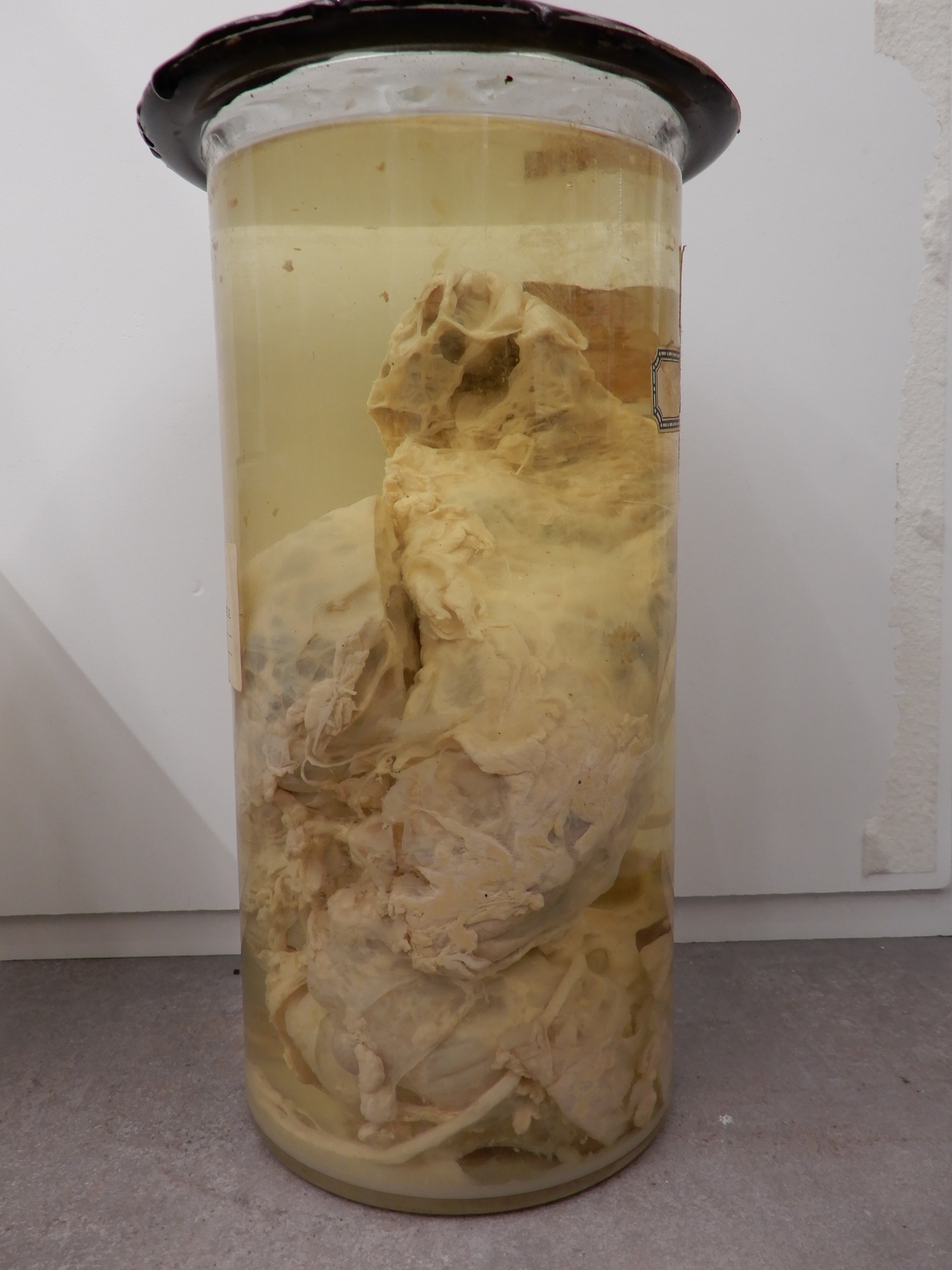 singolo reperto antropologico, preparato anatomico (morfologia alterata per patologia) (XIX-XX)