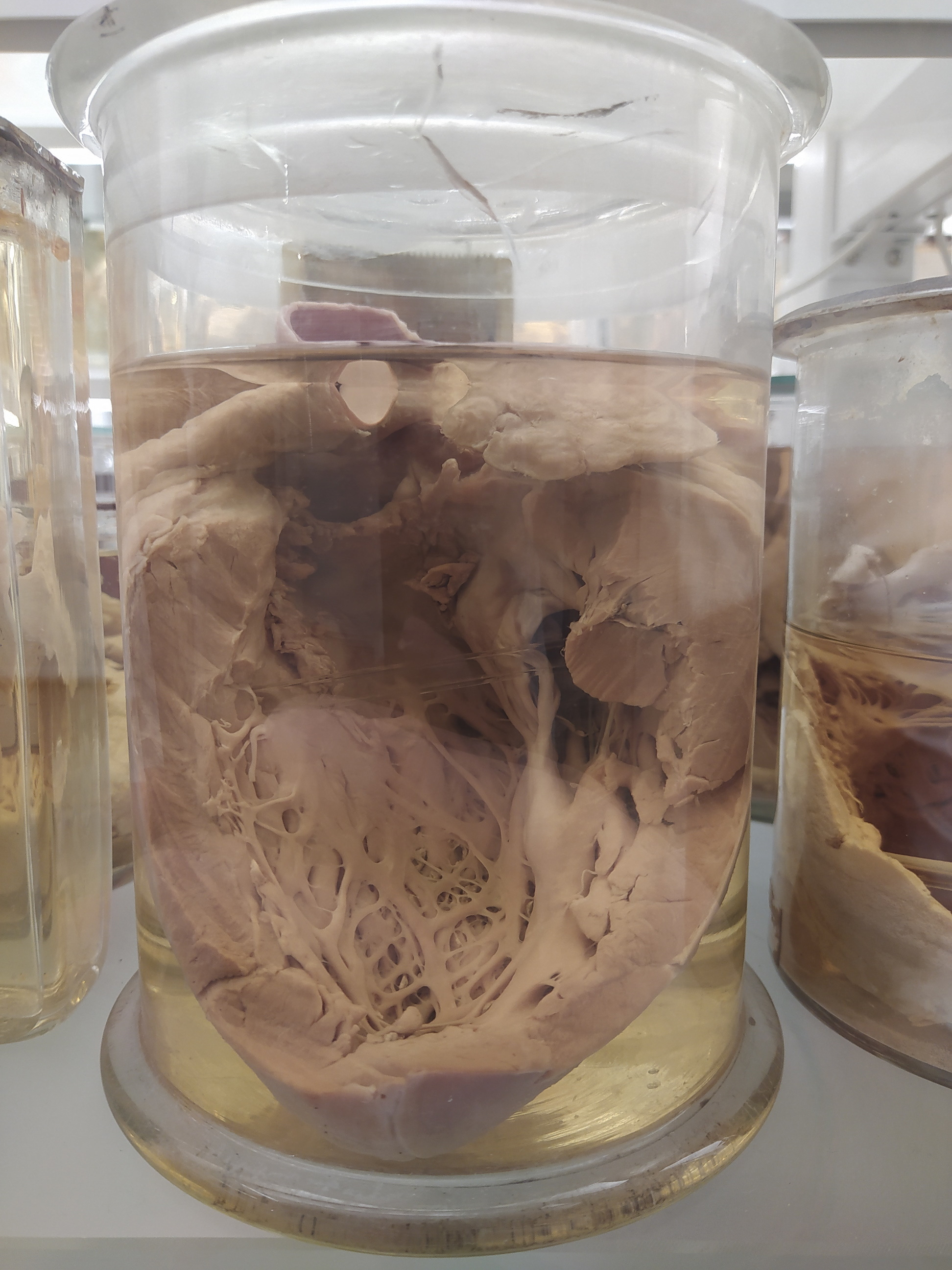 singolo reperto antropologico, preparato anatomico (morfologia alterata per patologia) (XIX-XX)