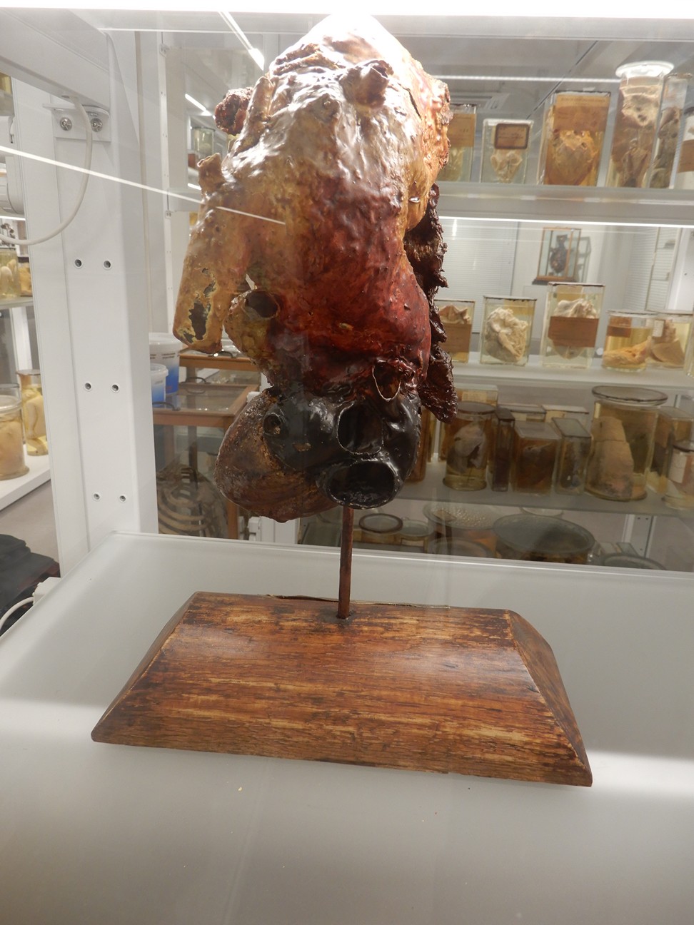 singolo reperto antropologico, preparato anatomico (morfologia alterata per patologia) (XIX-XX)