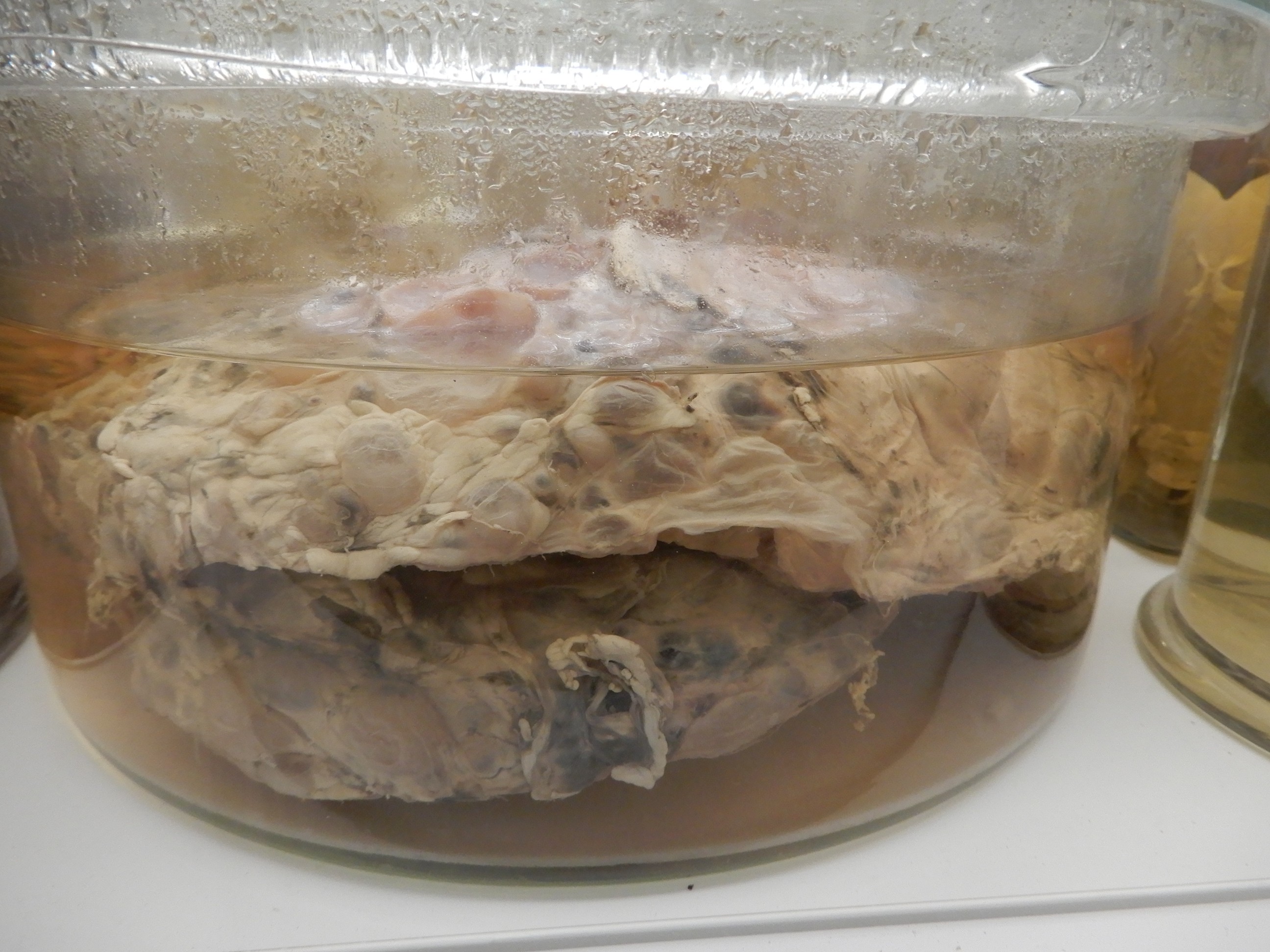 singolo reperto antropologico, preparato anatomico (morfologia alterata per patologia) (XIX-XX)