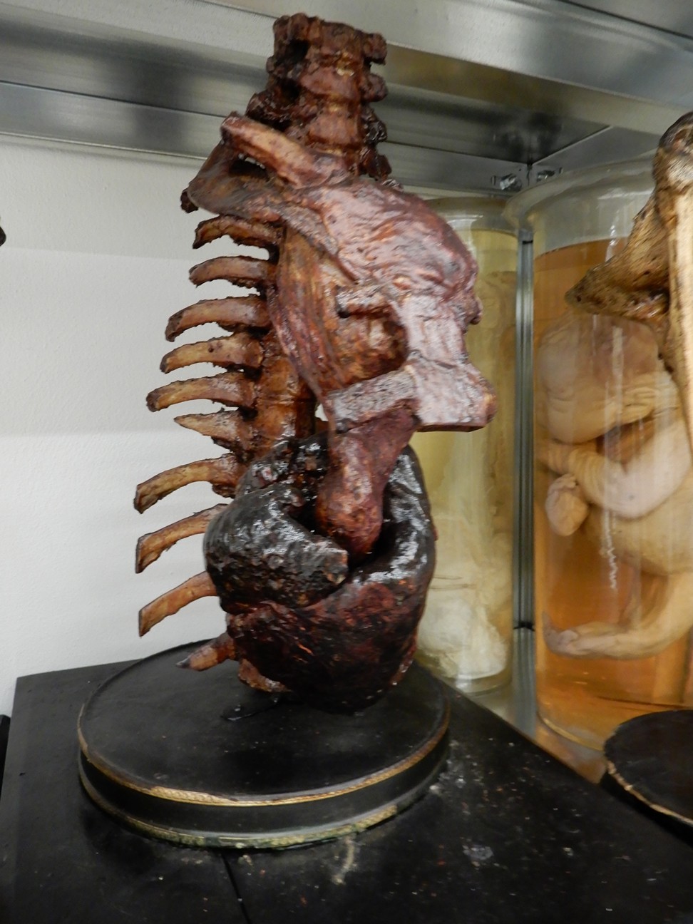 singolo reperto antropologico, preparato anatomico (morfologia alterata per patologia) (XIX-XX)