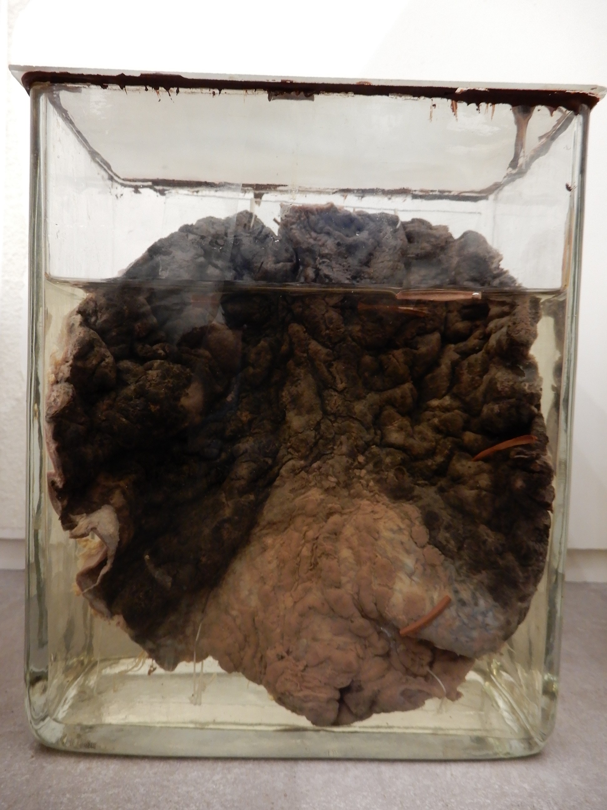 singolo reperto antropologico, preparato anatomico (morfologia alterata per patologia) (XIX-XX)