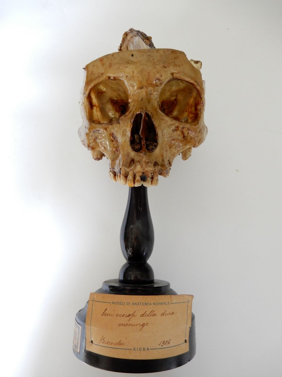 singolo reperto antropologico, preparato anatomico, meningi (morfologia/ struttura alterata post mortem per intervento antropico, trattato con fissante) (XX)