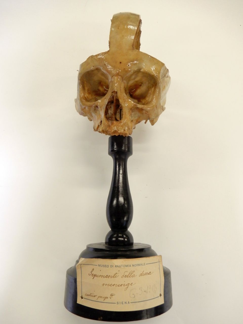 preparato anatomico, meningi (morfologia/ struttura alterata post mortem per intervento antropico, trattato con fissante) (XX)